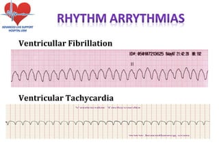 Ventricullar Fibrillation
Ventricular Tachycardia
 
