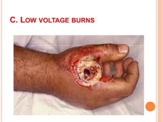 Electric Burn Example Electric burn | PPTX