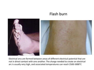 Electric burn injury- diagnosis and management | PPTX