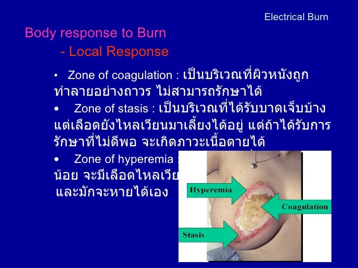 Electric Burn