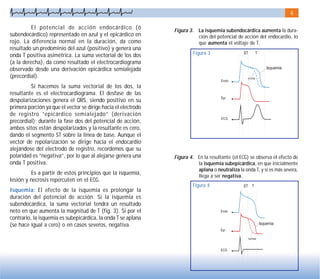 6
Figura 3. La isquemia subendocárdica aumenta la dura-
ción del potencial de acción del endocardio, lo
que aumenta el voltaje de T.
Figura 4. En la resultante (el ECG) se observa el efecto de
la isquemia subepicárdica, en que inicialmente
aplana o neutraliza la onda T, y si es más severa,
llega a ser negativa.
El potencial de acción endocárdico (ó
subendocárdico) representado en azul y el epicárdico en
rojo. La diferencia normal en la duración, da como
resultado un predominio del azul (positivo) y genera una
onda T positiva asimétrica. La suma vectorial de los dos
(a la derecha), da como resultado el electrocardiograma
observado desde una derivación epicárdica semialejada
(precordial).
Si hacemos la suma vectorial de los dos, la
resultante es el electrocardiograma. El desfase de las
despolarizaciones genera el QRS, siendo positivo en su
primera porción ya que el vector se dirige hacia el electrodo
de registro “epicárdico semialejado” (derivación
precordial); durante la fase dos del potencial de acción,
ambos sitos están despolarizados y la resultante es cero,
dando el segmento ST sobre la línea de base. Aunque el
vector de repolarización se dirige hacia el endocardio
alejándose del electrodo de registro, recordemos que su
polaridad es “negativa”, por lo que al alejarse genera una
onda T positiva.
Es a partir de estos principios que la isquemia,
lesión y necrosis repercuten en el ECG.
Isquemia: El efecto de la isquemia es prolongar la
duración del potencial de acción. Si la isquemia es
subendocárdica, la suma vectorial tendrá un resultado
neto en que aumenta la magnitud de T (fig. 3). Si por el
contrario, la isquemia es subepicárdica, la onda T se aplana
(se hace igual a cero) o en casos severos, negativa.
Figura 3
Figura 4
 