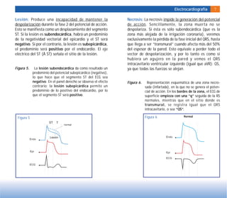Electrocardiografía 7
Lesión: Produce una incapacidad de mantener la
despolarización durante la fase 2 del potencial de acción.
Esto se manifiesta como un desplazamiento del segmento
ST. Si la lesión es subendocárdica, habrá un predominio
de la negatividad vectorial del epicardio y el ST será
negativo. Si por el contrario, la lesión es subepicárdica,
el predominio será positivo por el endocardio. El eje
eléctrico del ST (Â ST) señala el sitio de la lesión.
Figura 5. La lesión subendocárdica da como resultado un
predominio del potencial subepicárdico (negativo),
lo que hace que el segmento ST del ECG sea
negativo. En el panel derecho se observa el efecto
contrario: la lesión subepicárdica permite un
predominio de lo positivo del endocardio, por lo
que el segmento ST será positivo.
Figura 5 Figura 6
Necrosis: La necrosis impide la generación del potencial
de acción. Sencillamente, la zona muerta no se
despolariza. Si ésta es sólo subendocárdica (que es la
zona más alejada de la irrigación coronaria), veremos
exclusivamente la pérdida de la fase inicial del QRS, hasta
que llega a ser “transmural” cuando afecta más del 50%
del espesor de la pared. Esto equivale a perder todo el
vector de despolarización, y por lo tanto es como si
hubiera un agujero en la pared y vemos el QRS
intracavitario ventricular izquierdo (igual que aVR): QS,
ya que todas las fuerzas se alejan.
Figura 6. Representación esquemática de una zona necro-
sada (infartada), en la que no se genera el poten-
cial de acción. En los bordes de la zona, el ECG de
superficie empieza con una “q” seguida de la RS
normales, mientras que en el sitio donde es
transmural, se registra igual que el QRS
intracavitario, o sea “QS”.
 
