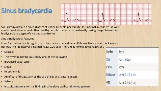Diagram of ecg