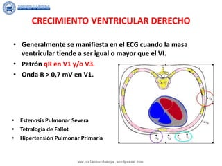 CRECIMIENTO VENTRICULAR DERECHO
• Generalmente se manifiesta en el ECG cuando la masa
ventricular tiende a ser igual o mayor que el VI.
• Patrón qR en V1 y/o V3.
• Onda R > 0,7 mV en V1.
• Estenosis Pulmonar Severa
• Tetralogía de Fallot
• Hipertensión Pulmonar Primaria
www.drleonardomoya.wordpress.com
 