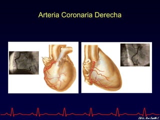 Arteria Coronaria Derecha 