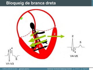 Electrocardiografia Per Atenci Prim ria 2 Transtorns De Conducci PDF
