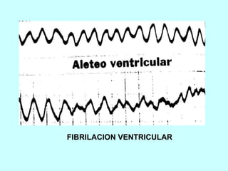 FIBRILACION VENTRICULAR
 