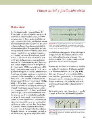 Flutter atrial y fibrilación atrial



Flutter atrial

En el primer estudio epidemio­lógico de
flutter atrial basado en la población general,
se encontró una incidencia de 88/100.000
personas-año. El flutter atrial tipo I (forma
típica o común del flutter atrial) tiene un asa
de reentrada bien de­fi­ni­da entre las dos cavas   Figura 173. Flutter atrial típico en contra de las manecillas del
                                                    reloj. Note ondas F negativas en las derivaciones inferiores y
en la aurícula derecha, depen­den­cia del ist­      positivas en V1. El bloqueo AV en este caso es variable: 3:1 (tres
mo cavotricuspídeo, siempre puede ser inte­         ondas F por un complejo QRS) y 2:1.

rrumpi­do mediante sobreestimulación atrial
rápida y puede tener un sentido en contra           me­dad cardíaca con­gé­nita. Los pacien­tes con
o a favor de las mane­cillas del reloj. Usual­      riesgo más alto de desarrollar flutter atrial
mente, la frecuencia atrial oscila entre 250        son los hombres, la edad avanzada y los
y 350 lpm si el paciente no está recibiendo         individuos con falla cardíaca o enfer­me­dad
medicación cronotrópica negativa. La forma          pulmo­nar obstructiva crónica previa.
más común de pre­sen­tación es bloqueo AV
2:1 (aurículas a 300 lpm y ven­trículos a 150       Las ondas P del flutter atrial reciben el nombre
lpm), pero puede presentarse 3:1, 4:1, etc. o       de ondas F o en dientes de tiburón, debido
puede ser bloqueo AV variable. El flutter tipo      a su forma característica al ECG (fig. 174).
I que hace un asa de reentrada con di­rección       Este tipo de ondas F se presentan de­bido a
en contra de las ma­ne­cillas del reloj se mani­    que a medida que aumenta la frecuencia del
fiesta al ECG por ondas P invertidas en las         foco ectópico, los períodos isoeléctricos se
derivaciones inferiores y positivas en V1 (fig.     hacen más cortos y las ondas Tp (ondas de
173). El flutter tipo I que gira en el sentido      repolarización auricular) adquieren mayor
de las manecillas del reloj se caracteriza por      voltaje.
ondas P positivas en las deri­va­ciones inferi­
ores y negativas en V1. El flutter atrial tipo II   La farmacoterapia para esta arritmia es simi­lar
(forma atípica o no común del flutter atrial)       a la que se describe a continuación para fi­bri­
no tiene un asa de reen­trada bien definida,
no se pue­de interrumpir por sobre­es­ti­mu­
lación, no tiene de­pen­dencia anatómica del
istmo cavo­tri­cuspídeo y su frecuencia atrial
oscila entre 350 y 430 lpm. Este flutter tipo
II tiene una pre­sen­tación variable al ECG.
Un tercer tipo de flutter recibe el nombre de
flutter incisional y se presenta en los pacien­     Figura 174. Ondas F en la derivación V1. Note que la frecuencia
                                                    auricular es de 250 lpm y la frecuencia ventricular es de 125 lpm
tes sometidos a reparo quirúrgico de enfer­         (bloqueo AV 2:1).

                                                                                                                  105
 