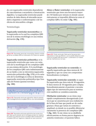 do con taqui­cardia ventricular depen­diente                          Aleteo o flutter ventricular: es la taquicardia
de cateco­la­minas o secundaria a intoxicación                        ventricular que tiene una frecuencia mayor
di­gi­tá­lica. La ta­qui­­car­dia ven­tri­cular puede                 de 250 latidos por minuto en donde caracte­
resultar de daño directo al mio­cardio secun­                         rísticamente es imposible diferenciar entre el
dario a is­que­mia o cardio­miopatía o de los                         complejo QRS y la onda T (fig. 181).
efectos de mio­carditis o drogas.

Terminología

Taquicardia ventricular mono­mórfica: es
la taquicardia en la cual los complejos QRS
son de la misma morfología en una misma
derivación (fig. 178).




Figura 178. Taquicardia ventricular monomórfica. Note la mor­fo­lo­
                                                                      Figura 181. Flutter ventricular. Note que la frecuencia de la
gía de los complejos QRS en la derivación DII (Todos son iguales).
                                                                      taquicardia es mayor de 250 lpm y no es posible diferenciar clara­
                                                                      mente el complejo QRS de la onda T. La derivación V2 muestra
                                                                      además interferencia en el trazo.
Taquicardia ventricular polimórfica: es la
taquicardia ventricular que cursa con varia­
ción de la morfología de los complejos QRS
en una misma derivación. Si la mor­fo­logía                           Taquicardia ventricular no sostenida: es
de los complejos QRS varía indistinta­mente                           aquella taqui­car­dia que dura menos de 30
de un latido a otro se denomina ta­quicardia                          segundos y que no cursa con compromiso
ventricular poli­mór­­fica (fig. 179) y si la varia­                  hemodinámico (colapso).
ción de la morfología es cíclica se de­no­mina
taquicardia ventricular polimórfica tipo Tors­                        Taquicardia ventricular sos­te­nida: es aque­
ades de Pointes (puntas torcidas)                                     lla taqui­car­dia que dura más de 30 segun­dos.
(fig. 180).                                                           Si dura menos de 30 segundos pero colapsa
                                                                      hemo­di­námi­ca­mente al paciente y necesita
                                                                      algún tipo de inter­vención para su termi­na­
                                                                      ción también se considera sostenida.

                                                                      Fibrilación ventricular: es un ritmo muy
Figura 179. Taquicardia ventricular polimórfica. Note la variación
de la morfología entre los complejos QRS en una misma derivación.     rápido comple­ta­mente desorganizado (caó­
                                                                      tico) que se caracteriza por una ondu­lación
                                                                      de la línea de base que puede ser de ondas
                                                                      gruesas o finas que varían en contorno y
                                                                      amplitud, en donde no es posible dife­renciar
                                                                      claramente la presencia de complejos QRS-
Figura 180. Taquicardia ventricular poli­mórfica tipo puntas torci­   T (fig. 182). Si este ritmo no se desfibrila
das. Note que la variación de la morfología se hace con respecto      eléctricamente en forma precoz degenera en
al cambio en la dirección de los complejos QRS (inicialmente los
complejos QRS son negativos y después se hacen positivos).            asistolia ventricular y el pa­cien­te fallece.

1
	 12
 