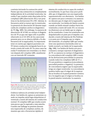 Taquicardias de complejos anchos

con­­ti­núa iniciando la contracción atrial.                         sistema de conducción es capaz de con­ducir
Puesto que esta con­tracción es completamente                        normalmente, lo que hace muy poco prob­
in­de­pendiente de la actividad ventricular, las                     able que el diagnóstico sea una taquicardia
on­das P que resultan están disociadas de los                        supraventricular con abe­rran­cia. Los latidos
comple­jos QRS (disociación AV) y son posi­                          de captura son poco comunes y su ausencia
tivas en las de­ri­va­ciones DI y DII. Además, la                    no descarta que el origen de la taquicardia
fre­cuencia atrial es menor que la ventricular.                      sea ventricular. Los latidos de fusión ocurren
La presencia de disociación AV durante taqui­                        cuando un latido sinusal con­du­ce hacia los
cardia de complejos anchos es diagnóstico                            ventrículos a través del nodo AV y se encuen­
de TV (fig. 189). Sin embargo, la ausencia de                        tra (fu­sio­na) con un latido que se ori­gina
disociación AV al EKG no exclu­ye el diag­nós­                       de los ventrículos. Como los ventrículos son
tico de TV ya que este signo sólo es posible                         des­po­larizados en parte por el impul­so con­
observarlo en el 20-30% de los casos (está                           ducido a través del sistema de His-Purkinje
presente pero no se observa debido a la alta                         y en parte por el impulso que se origina
fre­cuencia de la taquicardia). Es impor­tante                       del ventrículo, el complejo QRS que resulta
tener en cuenta que algunos pacientes con                            tiene una apa­riencia intermedia entre un
TV tienen con­ducción retró­grada hacia la au­                       latido normal y un latido de la taquicardia
rícula a través del nodo AV. En estos casos las                      (fig. 190). Los latidos de fusión son poco
ondas P resultantes son inver­ti­das y se obser­                     comunes y aun­que so­por­tan el diagnóstico
van después del comple­jo QRS, usual­mente                           de TV, su ausen­cia no excluye el diag­nós­tico.
con un inter­valo RP constante.                                      La concor­dan­cia del complejo QRS a través
                                                                     de las deri­va­ciones precordiales se presenta
                                                                     cuando todos los complejos QRS de V1 a
                                                                     V6 son positivos o negativos (concor­dancia
                                                                     precordial posi­ti­va o negativa). La presencia
                                                                     de concor­dancia sugiere que la taquicardia
                                                                     tenga un origen ventricular. La concordancia
                                                                     positiva indica que el origen de la taquicar­
                                                                     dia se localiza en la pared posterior ventricu­
                                                                     lar y la negativa que el origen se loca­li­za en
                                                                     la pared anterior ventricular. La ausencia


Figura 189. Disociación AV. Note que el tercer y el quinto latido,
tanto en el trazo superior como en el inferior, tienen una onda
inicial que deforma el complejo QRS (comparado con el segundo
y el cuarto complejo), que corresponde a una onda P.


Evidencia indirecta de actividad atrial inde­pen­
diente. Los latidos de captura se presentan cu­
ando un impulso atrial logra despo­larizar el
ventrículo a través del sistema de con­ducción
normal. El complejo QRS que resulta ocurre
más precoz que lo es­­pe­rado y más estrecho.
                                                                     Figura 190. Latido de fusión. Note que el tercer latido de este
Cuan­do este hallazgo se pre­sen­ta du­rante                         trazo muestra un complejo QRS con morfología diferente a los
una taquicardia de complejos anchos, de­                             otros complejos. Dicha morfología es intermedia entre un latido
                                                                     normal y uno de la taquicardia por lo cual recibe el nombre de
muestra que aún a frecuencias rápidas el                             latido de fusión.


                                                                                                                                  117
 