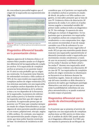 de concor­dan­cia precordial sugiere que el                       con­si­derar que, si el paciente con taquicardia
origen de la ta­qui­cardia sea supraventricular                   de complejos anchos se presenta en estado
(fig. 191).                                                       de shock, sin pulso o en falla car­díaca con­
                                                                  ges­tiva, es más sabio presumir que se trata de
                                                                  una TV. Evi­dencia clínica de diso­ciación AV
                                                                  (pre­sen­cia de ondas A en cañón en el pulso
                                                                  venoso yugular o intensidad variable del
                                                                  pri­mer ruido car­día­co) indica un diagnóstico
                                                                  de TV. Sin embargo, la ausencia de estos
                                                                  hallazgos no excluye el diagnóstico. En los
                                                                  pacientes que se presenten con taqui­car­dia
                                                                  de comple­jos anchos sin compromiso he­
                                                                  mo­dinámico o con compromiso leve, algu­
Figura 191. Concordancia precordial. Note que todos los           nos autores recomiendan el uso de masaje
complejos QRS de V1 a V6 son positivos (concordancia precordial   carotídeo con el fin de enlentecer la con­
positiva).
                                                                  ducción AV (au­menta el tono vagal sobre el
Diagnóstico diferencial basado                                    nodo AV) ya que esta maniobra puede de­sen­
en la presentación clínica                                        mascarar una ta­quicardia supraventricular al
                                                                  detenerla (reentrada nodal o taquicardia por
                                                                  movi­miento circular ortodrómico a través
Algunos aspectos de la historia clínica y el
                                                                  de una vía accesoria) o enlen­te­cerla (permite
examen físico pue­den ayudar en el diag­nós­
                                                                  ver las ondas F durante un flutter atrial o
tico diferencial de las taquicardias de comple­
                                                                  las ondas P´ durante una taqui­car­dia atrial
jos anchos. Si la taquicardia de complejos
                                                                  ectópica) y hace evi­den­te una disociación AV
anchos se presenta en un pa­cien­te mayor
                                                                  en caso de TV. Las taquicardias de complejos
de 35 años es más probable que su origen
                                                                  anchos de origen ventricular no disminuyen
sea ventricular. Si el paciente tiene historia
                                                                  su frecuen­cia ni se detienen durante las
de enfermedad co­ro­naria o falla cardíaca el
                                                                  manio­bras vagales. Antes de realizar el ma­
90% de los casos tendrá una taqui­car­dia de
                                                                  saje del seno carotídeo se debe des­car­tar la
complejos anchos de origen ventricular (TV).
                                                                  presencia de soplos que impliquen pato­logía
Los síntomas asociados con una taquicardia
                                                                  obstruc­ti­va a ese nivel ya que en esos casos
de complejos anchos dependen de las con­
                                                                  existe la po­si­bi­li­dad de embolismo de una
se­cuencias hemodi­námicas de la arritmia
                                                                  placa ate­ro­escle­rótica y se puede oca­sio­nar
y éstas a su vez dependen de la fre­cuen­cia
                                                                  un daño mayor al paciente.
de la taquicardia, la pre­sen­cia de enferme­
dad cardíaca previa y la función ventricu­
lar iz­­quier­da más bien que del origen de                       Diagnóstico diferencial con la
la arrit­mia. Es equi­vocado pensar que un                        ayuda de electrocardio­gra­mas
paciente con TV tiene que consultar siempre                       previos
en esta­do de colapso hemo­diná­mico, ya que
algunos de estos pacientes pueden presen­tar­                     Si el paciente que se presenta al servicio de
se con mareo, palpitaciones, síncope, angina                      urgencias con una taquicardia de complejos
o falla cardíaca. En contraste, una taqui­car­                    anchos tiene un EKG previo en ritmo sinu­
dia supra­ventricular puede colapsar al pa­                       sal, el análisis de dicho EKG puede ayudar
ciente que tiene pobre función ventricular                        en el diag­nóstico diferencial. Si el EKG pre­
de base. En términos de incidencia es útil                        vio muestra la pre­sen­cia de un blo­queo de

1
	 18
 