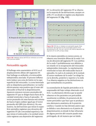 ST. La elevación del segmento ST se observa
                                                                en la mayoría de las derivaciones, excepto en
                                                                aVR y V1 en donde se registra una depresión
                                                                del segmento ST (fig. 199).




                                                                Figura 199. ECG de un individuo con pericarditis aguda. Note
                                                                la elevación del segmento ST de concavidad superior en las
                                                                derivaciones DI, aVL, DII, aVF y de V2 a V6. Note la depresión del
                                                                segmento ST en aVR y el bajo voltaje.



                                                                Si la injuria epicárdica es menos severa, se
Figura 198. Hallazgos típicos del ECG en individuos con embo­
lismo pulmonar agudo.                                           observa una inversión difusa de la onda T en
                                                                vez de elevación del segmento ST. Los cambios
                                                                de la onda T probablemente son debidos a
Pericarditis aguda                                              un retardo en la recuperación del miocardio
                                                                subepicárdico lesionado. La repolarización
El hallazgo más característico al ECG es el                     ventricular se hace del endocardio hacia el
desplazamiento difuso del segmento ST.                          epicardio, lo cual es al con­trario de lo normal.
Este hallazgo es atribuido a la miocarditis                     El vector resultante de la onda T se dirige ha­
subepi­cárdica asociada. El proceso inflama­                    cia la derecha, posterior y superior y la onda
torio induce una zona de lesión en la capa                      T se observa negativa en las deriva­cio­nes en
superficial del miocardio. La zona lesionada                    que normalmente era positiva.
sólo se despolariza parcial­men­te y se vuelve
eléc­tri­camente más positiva que el resto del                  La acumulación de líquido pericárdico es la
mio­cardio al final de la despo­larización.                     responsable del bajo voltaje observado en el
Apa­re­cen entonces vectores anormales del                      ECG. La alternancia eléctrica que se puede
seg­mento ST que se dirigen hacia fuera de la                   observar en los pa­cien­tes con pericarditis
cavidad ventricular y hacia el epicardio. El
                                                                usualmente es debida a la pre­sencia de de­
vector promedio de estas fuerzas está orien­ta­
                                                                rra­me peri­cár­dico que hace que se pro­duz­ca
do hacia el ápex car­día­co igual que el vec­tor
                                                                una alternancia ana­tó­mica de la posición
promedio del QRS (eje eléctrico). De esta
manera, las derivaciones que miran la super­                    car­día­ca. Cuando no hay derrame parece que
ficie epicár­dica registran una elevación del                   es debida a una alter­nancia en el patrón de
segmento ST (de concavidad superior) y las                      des­polarización en donde la fase refractaria
que miran el endocardio o la cavidad ventri­                    de alguna porción del corazón puede estar
cular registran una depresión del segmento                      prolongada, de tal ma­nera que un latido

1
	 28
 