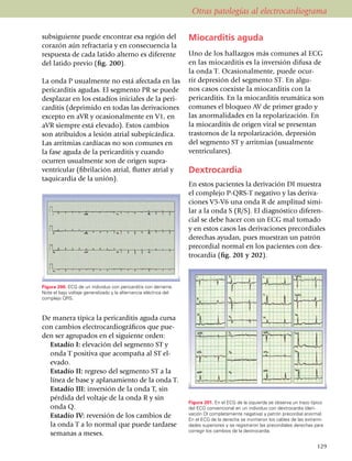 Otras patologías al electrocardiograma

subsi­guiente puede encontrar esa región del                       Miocarditis aguda
corazón aún refrac­ta­ria y en consecuencia la
res­pues­ta de cada latido alterno es diferente                    Uno de los hallazgos más comu­nes al ECG
del latido previo (fig. 200).                                      en las mio­car­ditis es la inversión difusa de
                                                                   la onda T. Ocasio­nal­mente, puede ocur­
La onda P usualmente no está afectada en las                       rir depresión del segmento ST. En algu­
pericarditis agudas. El segmento PR se puede                       nos casos coexiste la miocarditis con la
desplazar en los estadíos iniciales de la pe­ri­­                  pericar­ditis. En la mio­carditis reumática son
car­ditis (de­pri­mido en todas las deri­va­ciones                 co­mu­nes el bloqueo AV de primer grado y
excepto en aVR y ocasio­nal­men­te en V1, en                       las anorma­li­da­des en la repolarización. En
aVR siempre está elevado). Estos cambios                           la mio­car­ditis de origen viral se pre­sen­tan
son atribuidos a lesión atrial subepi­cárdica.                     trastornos de la repo­la­ri­za­ción, depresión
Las arrit­mias cardíacas no son comunes en                         del segmento ST y arritmias (usualmente
la fase aguda de la pericarditis y cuan­do                         ventriculares).
ocu­rren usual­­men­te son de origen supra­
ventricular (fibri­la­ción atrial, flutter atrial y                Dextrocardia
ta­qui­cardia de la unión).
                                                                   En estos pacientes la derivación DI muestra
                                                                   el complejo P-QRS-T negativo y las deriva­
                                                                   ciones V5-V6 una onda R de amplitud simi­
                                                                   lar a la onda S (R/S). El diagnóstico diferen­
                                                                   cial se debe hacer con un ECG mal tomado
                                                                   y en estos casos las deriva­cio­nes precor­diales
                                                                   derechas ayudan, pues muestran un patrón
                                                                   precordial normal en los pacientes con dex­
                                                                   trocardia (fig. 201 y 202).



Figura 200. ECG de un individuo con pericarditis con derrame.
Note el bajo voltaje generalizado y la alternancia eléctrica del
complejo QRS.



De manera típica la pericarditis aguda cursa
con cambios electro­­cardiográficos que pue­
den ser agrupados en el siguiente orden:
	 Estadío I: elevación del segmento ST y
  onda T positiva que acompaña al ST el­
  evado.
	 Estadío II: regreso del segmento ST a la
  línea de base y aplanamiento de la onda T.
	 Estadío III: inversión de la onda T, sin
  pérdida del voltaje de la onda R y sin
                                                                   Figura 201. En el ECG de la izquierda se observa un trazo típico
  onda Q.                                                          del ECG conven­cional en un individuo con dextrocardia (deri­
	 Estadío IV: reversión de los cambios de                          vación DI completamente negativa) y patrón precordial anormal.
                                                                   En el ECG de la derecha se invirtieron los cables de las extremi­
  la onda T a lo normal que puede tardarse                         dades superiores y se registraron las precordiales derechas para
                                                                   corregir los cambios de la dextrocardia.
  semanas a meses.
                                                                                                                                 129
 