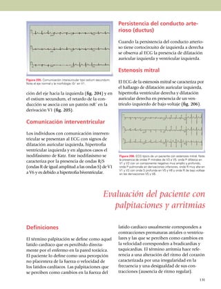 Persistencia del conducto arte-
                                                                rioso (ductus)

                                                                Cuando la persistencia del conducto arte­rio­
                                                                so tiene corto­cir­cuito de izquierda a derecha
                                                                se observa al ECG la presencia de dilatación
                                                                auricular izquierda y ventricular izquierda.

                                                                Estenosis mitral
Figura 205. Comunicación interauricular tipo ostium secundum.
Note el eje normal y la morfología rSr´ en V1.                  El ECG de la estenosis mitral se caracteriza por
                                                                el hallazgo de dilatación auricular iz­quierda,
ción del eje hacia la izquierda (fig. 204) y en                 hipertrofia ventricular derecha y di­la­ta­ción
el ostium secundum, el retardo de la con­                       auricular derecha en presencia de un ven­
ducción se asocia con un patrón rsR´ en la                      trículo izquierdo de bajo voltaje (fig. 206).
derivación V1 (fig. 205).

Comunicación interventricular

Los individuos con comu­ni­ca­ción interven­
tricular se presen­tan al ECG con signos de
di­latación auricular izquierda, hiper­trofia
ventricular izquier­da y en algunos casos el
isodi­fa­sismo de Katz. Este isodi­fa­sismo se                  Figura 206. ECG típico de un paciente con estenosis mitral. Note
                                                                la presencia de on­das P mitrales de V3 a V5, onda P difásica en
caracteriza por la presencia de ondas R/S                       V1 y V2 con un componente negativo muy amplio y profundo,
(ondas R de igual amplitud a las ondas S) de V1                 onda P pulmonale en derivaciones inferiores, onda R muy alta en
                                                                V1 y V2 con onda S profunda en V5 y V6 y onda R de bajo voltaje
a V6 y es de­bido a hipertrofia biven­tricu­lar.                en las derivaciones V5 y V6.




                                             	         Evaluación del paciente con
                                                          palpitaciones y arritmias

Definiciones                                                    latido cardíaco usualmente corres­ponden a
                                                                contracciones pre­ma­turas atriales o ventri­cu­
El término palpitación se de­fine como aquel                    lares y las que se perciben como cambios en
latido cardíaco que es percibido direc­ta­                      la velocidad corres­ponden a bradicardias y
men­te por el enfermo en la pared torá­ci­ca.                   taqui­cardias. El término arritmia hace refe­
El paciente lo define como una percepción                       ren­cia a una alteración del ritmo del corazón
no placentera de la fuerza o velocidad de                       carac­te­ri­zada por una irregularidad en la
los la­tidos car­día­cos. Las pal­pi­ta­ciones que              fre­cuencia y una desigualdad de sus con­
se perciben como cambios en la fuerza del                       tracciones (ausencia de ritmo regular).
                                                                                                                            131
 