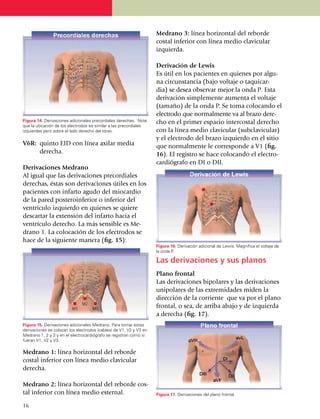 Medrano 3: línea horizontal del reborde
                                                                    costal inferior con línea medio clavicular
                                                                    izquier­da.

                                                                    Derivación de Lewis
                                                                    Es útil en los pacientes en quie­nes por al­gu­
                                                                    na circunstancia (bajo voltaje o taquicar­
                                                                    dia) se desea observar mejor la onda P. Esta
                                                                    de­ri­va­ción simplemente aumenta el voltaje
                                                                    (ta­ma­ño) de la onda P. Se toma colocando el
                                                                    electrodo que normalmente va al brazo de­re­
Figura 14. Derivaciones adicionales precordiales derechas. Note     cho en el primer espacio intercostal derecho
que la ubicación de los electrodos es similar a las precordiales
izquierdas pero sobre el lado derecho del tórax.                    con la línea medio clavicular (sub­clavicular)
                                                                    y el electrodo del brazo izquierdo en el sitio
V6R:	 quinto EID con línea axilar media                             que normalmente le corresponde a V1 (fig.
      derecha.                                                      16). El registro se hace colocando el elec­tro­
                                                                    cardiógrafo en DI o DII.
Derivaciones Medrano
Al igual que las derivaciones precordiales
derechas, éstas son derivaciones útiles en los
pa­cientes con infarto agudo del miocardio
de la pared poste­ro­inferior o inferior del
ventrículo izquierdo en quienes se quiere
descartar la extensión del infarto hacia el
ventrículo derecho. La más sensible es Me­
drano 1. La colocación de los electrodos se
hace de la siguiente manera (fig. 15):
                                                                    Figura 16. Derivación adicional de Lewis. Magnifica el voltaje de
                                                                    la onda P.

                                                                    Las derivaciones y sus planos
                                                                    Plano frontal
                                                                    Las derivaciones bipolares y las derivaciones
                                                                    unipolares de las extremidades miden la
                                                                    direc­ción de la corriente que va por el plano
                                                                    frontal, o sea, de arriba abajo y de izquierda
                                                                    a derecha (fig. 17).
Figura 15. Derivaciones adicionales Medrano. Para tomar estas
derivaciones se colocan los electrodos (cables) de V1, V2 y V3 en
Medrano 1, 2 y 3 y en el electrocardiógrafo se registran como si
fueran V1, V2 y V3.

Medrano 1: línea horizontal del reborde
costal inferior con línea medio clavicular
derecha.

Medrano 2: línea horizontal del reborde cos­
tal inferior con línea medio esternal.                              Figura 17. Derivaciones del plano frontal.

16
 