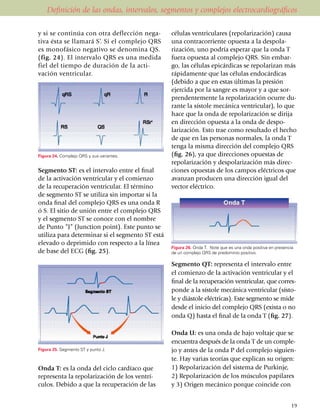 Definición de las ondas, intervalos, segmentos y complejos electrocardiográficos

y si se continúa con otra deflección nega­       células ventriculares (repolarización) causa
tiva ésta se llamará S’. Si el complejo QRS      una contracorriente opuesta a la despo­la­
es monofásico negativo se denomina QS.           rización, uno podría esperar que la onda T
(fig. 24). El intervalo QRS es una medida        fuera opuesta al complejo QRS. Sin embar­
fiel del tiempo de duración de la acti­          go, las células epicárdicas se repolarizan más
vación ventricular.                              rápidamente que las células endo­cár­dicas
                                                 (debido a que en estas últimas la pre­sión
                                                 ejercida por la sangre es mayor y a que sor­
                                                 prendentemente la repola­ri­zación ocurre du­
                                                 rante la sístole mecánica ventricular), lo que
                                                 hace que la onda de repolari­za­ción se dirija
                                                 en dirección opuesta a la onda de despo­
                                                 larización. Esto trae como resultado el hecho
                                                 de que en las personas normales, la onda T
                                                 tenga la misma dirección del comple­jo QRS
Figura 24. Complejo QRS y sus variantes.         (fig. 26), ya que direcciones opuestas de
                                                 repo­larización y despolari­zación más direc­
Segmento ST: es el intervalo entre el final      ciones opuestas de los campos eléc­tri­cos que
de la activación ventricular y el comienzo       avanzan producen una dirección igual del
de la recuperación ventricular. El término       vector eléctrico.
de segmento ST se utiliza sin importar si la
onda final del complejo QRS es una onda R
ó S. El sitio de unión entre el complejo QRS
y el segmento ST se conoce con el nombre
de Punto “J” (Junction point). Este punto se
utiliza para determinar si el segmento ST está
elevado o deprimido con respecto a la línea
                                                 Figura 26. Onda T. Note que es una onda positiva en presencia
de base del ECG (fig. 25).                       de un complejo QRS de predominio positivo.

                                                 Segmento QT: representa el intervalo entre
                                                 el comienzo de la activación ventricular y el
                                                 final de la recuperación ventricular, que co­rres­
                                                 ponde a la sístole mecánica ventricular (sís­to­
                                                 le y diástole eléctricas). Este segmento se mi­de
                                                 desde el inicio del complejo QRS (exista o no
                                                 onda Q) hasta el final de la onda T (fig. 27).

                                                 Onda U: es una onda de bajo voltaje que se
                                                 encuentra después de la onda T de un comple­
Figura 25. Segmento ST y punto J.                jo y antes de la onda P del complejo si­guien­
                                                 te. Hay varias teorías que explican su origen:
Onda T: es la onda del ciclo cardíaco que        1) Repola­rización del sistema de Purkinje,
representa la repolarización de los ven­trí­     2) Repola­rización de los músculos papi­­lares
cu­los. Debido a que la recuperación de las      y 3) Origen mecánico porque coin­­cide con


                                                                                                             19
 