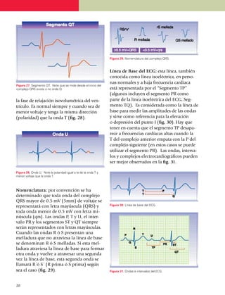 Figura 29. Nomenclatura del complejo QRS.



                                                                 Línea de Base del ECG: esta línea, también
                                                                 conocida como línea isoeléctrica, en perso­
                                                                 nas normales y a baja frecuencia cardíaca
Figura 27. Segmento QT. Note que se mide desde el inicio del
complejo QRS exista o no onda Q.                                 está representada por el “Segmento TP”
                                                                 (algunos incluyen el segmento PR como
la fase de relajación isovolu­mé­trica del ven­                  parte de la línea isoeléctrica del ECG, Seg­
trí­cu­lo. Es normal siempre y cuando sea de                     mento TQ). Es considerada como la línea de
me­nor voltaje y tenga la mis­ma dirección                       base para medir las amplitudes de las ondas
(pola­ri­dad) que la onda T (fig. 28).                           y sirve como referencia para la elevación
                                                                 o depresión del punto J (fig. 30). Hay que
                                                                 tener en cuenta que el segmento TP desa­pa­
                                                                 rece a frecuencias cardíacas altas cuando la
                                                                 T del complejo anterior empata con la P del
                                                                 complejo siguiente (en estos casos se puede
                                                                 utilizar el segmento PR). Las ondas, inter­va­
                                                                 los y complejos electro­cardiográficos pueden
                                                                 ser mejor observados en la fig. 31.

Figura 28. Onda U. Note la polaridad igual a la de la onda T y
menor voltaje que la onda T.



Nomenclatura: por convención se ha
determinado que toda onda del complejo
QRS mayor de 0.5 mV (5mm) de voltaje se
representará con letra mayús­cula (QRS) y                        Figura 30. Línea de base del ECG.

toda onda menor de 0.5 mV con letra mi­
núscula (qrs). Las ondas P, T y U, el inter­
valo PR y los segmentos ST y QT siempre
serán represen­tados con letras ma­yúsculas.
Cuando las ondas R ó S pre­sentan una
mella­dura que no atraviesa la línea de base
se denominan R ó S melladas. Si esta mel­
ladura atraviesa la línea de base para formar
otra onda y vuelve a atravesar una segunda
vez la línea de base, esta segunda onda se
llamará R´ó S´ (R prima ó S prima) según
sea el caso (fig. 29).                                           Figura 31. Ondas e intervalos del ECG.



20
 