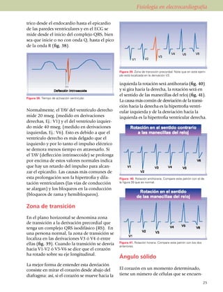 Fisiología en electrocardiografía

trico desde el endocardio hasta el epi­car­dio
de las paredes ventriculares y en el ECG se
mide desde el inicio del complejo QRS, bien
sea que inicie o no con onda Q, hasta el pico
de la onda R (fig. 38).




                                                     Figura 39. Zona de transición precordial. Note que en este ejem­
                                                     plo está localizada en la derivación V3.

                                                     izquierda la rotación será antihoraria (fig. 40)
                                                     y si gira hacia la derecha, la rotación será en
                                                     el sentido de las manecillas del reloj (fig. 41).
Figura 38. Tiempo de activación ventricular.
                                                     La causa más común de desviación de la tran­si­
                                                     ción hacia la derecha es la hiper­trofia ventri­
Normalmente, el TAV del ventrículo derecho           cular izquierda y de la desviación hacia la
mide 20 mseg. (medido en derivaciones                izquierda es la hipertrofia ventricular derecha.
de­rechas, Ej.: V1) y el del ventrí­culo iz­quier­
do mide 40 mseg. (medido en derivaciones
iz­quier­das, Ej.: V6). Esto es debido a que el
ventrículo derecho es más del­gado que el
izquierdo y por lo tanto el impulso eléctrico
se de­mora menos tiempo en atravesarlo. Si
el TAV (deflección in­trin­secoide) se pro­longa
por encima de estos valores norma­les indica
que hay un retardo del impulso para alcan­
zar el epicar­dio. Las causas más comu­nes de
esta prolon­gación son la hiper­trofia y dila­       Figura 40. Rotación antihoraria. Compare este patrón con el de
ta­ción ventriculares (las vías de conducción        la figura 39 que es normal.

se alargan) y los bloqueos en la conducción
(bloqueos de rama y hemiblo­queos).

Zona de transición
En el plano horizontal se denomina zona
de transición a la derivación precordial que
tenga un complejo QRS isodifásico (RS). En
una persona normal, la zona de transición se
localiza en las derivaciones V3 ó V4 ó entre
                                                     Figura 41. Rotación horaria. Compare este patrón con los dos
ellas (fig. 39). Cuando la transición se desvía      anteriores.
hacia V1-V2 ó V5-V6 se dice que el corazón
ha rotado sobre su eje longitudinal.
                                                     Ángulo sólido
La mejor forma de entender esta desviación
consiste en mirar el corazón desde abajo del         El corazón en un momento determinado,
diafragma: así, si el corazón se mueve hacia la      tiene un número de células que se encuen­
                                                                                                                    25
 