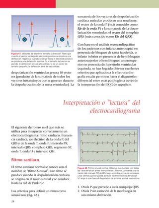 sumatoria de los vectores de despolarización
                                                                     cardíaca auricu­lar producen una resul­tan­te:
                                                                     el vector de la onda P (más conocido como
                                                                     Eje de la onda P) y la sumatoria de la des­po­
                                                                     la­rización ventricular: el vector del complejo
                                                                     QRS (más conocido como Eje del QRS).

                                                                     Con base en el análisis vectocardiográfico
                                                                     de los pacientes con infarto antero­septal en
Figura 47. Vectores de diferente tamaño y dirección. Note que        presencia de bloqueo de rama iz­quierda, o
cuando el vector se aleja del electrodo positivo se produce una      infarto inferior en presencia de hemi­bloqueo
deflección negativa y cuando se dirige hacia el electrodo positivo
se produce una deflección positiva. Si el tamaño del vector es       antero­superior o hemibloqueo anterosu­pe­
grande, la deflección será de alto voltaje, si es un vector de       rior en presencia de hiper­trofia ventricular
tamaño pequeño, la deflección será de bajo voltaje.
                                                                     izquierda, se han logrado obtener excelentes
despo­la­rización ventricular genera 10 vec­to­                      criterios que aplicados a la electrocar­dio­
res (producto de la su­ma­toria de todos los                         gra­fía escalar permiten hacer el diagnóstico
vectores instantáneos que se generan durante                         di­ferencial entre estas pato­logías a través de
la despolarización de la masa ventricular). La                       la interpreta­ción del ECG de superficie.




                                                       Interpretación o “lectura” del
                                                                 electrocardiograma

El siguiente derrotero es el que más se
utiliza para interpretar correctamente un
electrocardio­grama: ritmo cardíaco, frecuen­
cia cardíaca, eje eléctrico de la onda P, del
QRS y de la onda T, onda P, intervalo PR,
intervalo QRS, complejo QRS, segmento ST,
onda T, onda U e intervalo QTc.

Ritmo cardíaco
El ritmo cardíaco normal se conoce con el                            Figura 48. Ritmo sinusal normal. Observe que cumple con todas
nombre de “Ritmo Sinusal”. Este ritmo se                             las características antes mencionadas. Además, presenta una va­
                                                                     riación del intervalo RR de 80 mseg. entre los primeros complejos
produce cuando la despolarización car­­día­ca                        y los últimos que se puede apreciar fácilmente en la derivación
se origina en el nodo sinusal y se conduce                           V1 larga lo que hace el diagnós­tico de arritmia sinusal respiratoria.

hasta la red de Purkinje.
                                                                     1.	 Onda P que precede a cada complejo QRS.
Los criterios para definir un ritmo como                             2.	 Onda P sin variación de la morfología en
sinusal son: (fig. 48)                                                   una misma de­rivación.
28
 
