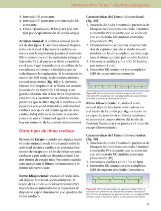 Interpretación o “lectura” del electrocardiograma

3.	 Intervalo PR constante.                        Características del Ritmo Idiojuncional:
4.	 Intervalo PP constante con intervalo RR        (fig. 49)
    constante.                                     1.	 Ausencia de onda P normal o presencia de
5.	 Onda P positiva en DI-DII y aVF (eje in­fe­        bloqueo AV completo con onda P normal
    rior por despo­la­rización de arriba-abajo).       e intervalo PP constante que no coincide
                                                       con el intervalo RR también constante
Arritmia Sinusal: la arritmia sinusal puede            (diso­ciación AV).
ser de dos tipos: 1. Arritmia Sinusal Res­pi­ra­   2.	 Ocasionalmente se pueden observar lati­
toria, en la cual la frecuencia cardíaca au­           dos de captura (cuan­do el nodo sinusal
menta con la inspiración (acorta el intervalo          produce un latido completo, es decir, cap­
RR) y dis­mi­nuye con la espiración (alarga el         tura el ritmo cardíaco por un sólo latido).
intervalo RR), al parecer se debe a cambios        3.	 Frecuencia cardíaca entre 40 y 60 latidos
en el tono vagal se­cun­dario a un reflejo de la       por minuto (lpm).
vas­cu­la­tura pulmonar y sistémica que su­        4.	 Intervalos RR constantes con complejos
cede durante la respiración. Si la variación es        QRS de carac­te­rísticas normales.
me­nor de 160 mseg. se denomina arritmia
sinusal respiratoria (fig. 48) y 2. Arritmia
Sinusal No Respiratoria: se llama así cuando
la variación es mayor de 160 mseg. y no
guarda relación con la fase de la respiración.     Figura 49. Ritmo idiojuncional. Note la ausencia de onda P,
                                                   intervalos RR constantes con complejos QRS de características
Esta arritmia usual­mente se observa en los        normales y frecuencia cardíaca de 56 lpm.
pacientes que reciben digital o morfina o en       Ritmo Idioventricular: cuando el nodo
pacientes con edad avanzada y enfermedad           sinusal deja de fun­cionar adecuadamente
cardíaca o después del infarto agudo de mio­       y el tejido de la unión por alguna razón no
cardio (IAM) inferior o durante la con­va­le­      es capaz de reaccionar en forma oportuna,
cencia de una enfermedad aguda o cuando            se aumenta el automatismo del tejido de
hay un aumento de la presión intracraneana.        Purkinje Ventricular y se produce el ritmo de
                                                   escape idioventricular.
Otros tipos de ritmo cardíaco
                                                   Características del Ritmo Idioventricular:
Ritmos de Escape: cuando por alguna razón          (fig. 50)
el nodo sinusal pierde el comando sobre la         1.	 Ausencia de onda P normal o presencia de
actividad eléctrica cardíaca se presentan los          bloqueo AV completo con onda P normal
ritmos de escape con el fin de evitar un paro          e intervalo PP constante que no coincide
cardíaco y por ende un desenlace fatal. Los            con el intervalo RR también constante
dos ritmos de escape más frecuentes cuando             (diso­cia­ción AV).
                                                   2.	 Frecuencia cardíaca entre 15 y 40 lpm.
esto sucede son el Ritmo Idiojuncio­nal y el
                                                   3.	 Intervalos RR constantes con complejos
Ritmo Idioventricular.
                                                       QRS de aspecto ventricular (se­me­jan a
Ritmo Idiojuncional: cuando el nodo sinu­
sal deja de fun­cio­nar adecuadamente, el
tejido de la unión auriculoventri­cular (AV)
mani­fiesta su automa­tis­mo o capacidad de        Figura 50. Ritmo idioventricular. Se observan ondas P que no
dis­pa­rarse espontáneamente y se apodera del      conducen por presencia de bloqueo AV completo (disociación
                                                   AV). El ritmo de escape es de tipo ventricular con complejos QRS
ritmo cardíaco.                                    anchos y onda T opuesta al QRS y la frecuencia es de 30 lpm.


                                                                                                                29
 