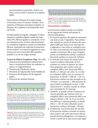 una extrasístole ven­tricular, es decir, an­
     chos y con la onda T opuesta al complejo
     QRS).
                                                                      Figura 53. Ritmo irregular por la presencia de fibrilación atrial.
Estos ritmos se llaman de escape porque                               Note la ausencia clara de ondas P que han sido reemplazadas por
                                                                      ondas “f” y la marcada variabilidad del intervalo RR. En este caso
es la forma como el corazón “escapa” de la                            el ritmo no es de origen sinusal.
asistolia, el bloqueo sinoatrial completo, el
bloqueo AV completo y la bradicardia sinu­
                                                                      Frecuencia cardíaca
sal severa.                                                           La frecuencia cardíaca puede ser medida
                                                                      de las siguientes formas utilizando el
El ritmo puede ser regular o irregular. El ritmo                      electrocar­diograma:
sinusal se consi­dera regular cuando los inter­                       1.	 En la parte superior del papel se encuentra
valos PP y RR son iguales y cons­tantes. El rit­                          una marca cada 3 segundos. Para utilizar
mo idiojun­cio­nal y el ritmo idioventricular                             este método se cuenta el número de com­
se consi­deran regulares cuando los intervalos                            plejos QRS que haya en un intervalo de
RR son constantes sin importar la presencia                               6 segun­dos y este valor se multiplica por
de las ondas P. Los ritmos irregulares se carac­                          10. Este es un método útil especial­mente
te­ri­zan por tener intervalos RR variables y                             cuando el intervalo RR es muy irregular
pueden o no ser de origen sinusal.                                        (como en la fibrilación atrial) o cuando la
                                                                          frecuencia car­díaca es mayor de 100 lpm.
Causas de Ritmos Irregulares: (figs. 51 a 53)                         2.	El método más exacto de medir la fre­
1.	 Presencia de extrasístoles supraven­tri­cu­                           cuencia cardíaca utilizando el ECG
    lares o ventriculares (bien sea aisladas, en                          consiste en contar el número de cajon­
    pares o en bigeminismo).                                              ci­tos pequeños que existen entre un
2.	 Presencia de Fibrilación Atrial.                                      complejo QRS y otro (intervalo RR) y
3.	 Presencia de Taquicardia Atrial Multifocal.                           dividir a 1.500 por ese valor. Ej: si entre
4.	 Presencia de bloqueos AV de segundo                                   un complejo QRS y otro se cuentan 10
    grado.                                                                cajoncitos, se divide 1.500/10 = 150. La
5.	 Presencia de Arritmia Sinusal.                                        frecuencia cardíaca en este ejemplo es de
                                                                          150 lpm. La constante 1.500 proviene de
                                                                          que el electrocar­diógrafo recorre 1.500
                                                                          cajoncitos en 1 minu­to cuando se utiliza
                                                                          una velocidad de 25 mm/seg.
                                                                      3.	También, se puede contar el número de
Figura 51. Ritmo sinusal irregular interrumpido por un complejo           cajones grandes que existan entre un
atrial prematuro (extrasístole supraventricular). Observe que el
quinto complejo PQRS sucede con una distancia menor que los
                                                                          complejo QRS y otro (intervalo RR) y ese
precedentes, la onda P es de diferente morfología a las previas y         número divide a 300. Ej: Si en un inter­
el complejo QRS es de características normales.
                                                                          va­lo RR hay 2 cajones grandes, se divide
                                                                          300/2 = 150. El valor obtenido será la
                                                                          frecuencia cardíaca calculada, 150 lpm.
                                                                      4.	Finalmente, una forma fácil de calcular
Figura 52. Ritmo sinusal irregular por la presencia de arritmia
                                                                          la frecuencia cardíaca consiste en memo­
sinusal respiratoria y de un complejo ventricular prematuro (extra­       rizar cuánto vale cada raya oscura del pa­
sístole ventricular). Observe que el complejo QRS número 9 de
izquierda a derecha, tiene morfología y dirección diferente a los
                                                                          pel del electrocardiograma y se empieza a
previos y no tiene onda P precedente.                                     contar a partir de la raya oscura que sigue

30
 
