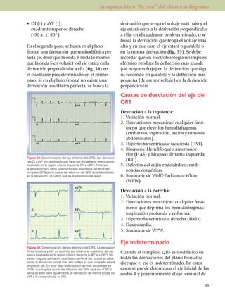 Interpretación o “lectura” del electrocardiograma

•	 DI (-) y aVF (-):                                                     derivación que tenga el voltaje más bajo y el
	 cuadrante superior derecho                                             eje estará cerca a la derivación perpendicular
	 (-90 a ±180°)                                                          a ella, en el cuadrante predeterminado, o se
                                                                         busca la derivación que tenga el voltaje más
En el segundo paso, se busca en el plano                                 alto y en este caso el eje estará o paralelo o
frontal una deri­vación que sea isodifásica per­                         en la misma derivación (fig. 59). Se debe
fecta (es decir que la onda R mida lo mismo                              recordar que en electrofi­siología un impulso
que la onda S en voltaje) y el eje estará en la                          eléctrico produce la deflección más grande
derivación perpendicular a ella (fig. 58) en                             (de mayor voltaje) en la derivación que siga
el cuadrante predeterminado en el primer                                 su recorrido en paralelo y la deflección más
paso. Si en el plano frontal no existe una                               pequeña (de menor voltaje) en la derivación
derivación isodifásica perfecta, se busca la                             perpendicular.

                                                                         Causas de desviación del eje del
                                                                         QRS
                                                                         Desviación a la izquierda:
                                                                         1.	 Variación normal.
                                                                         2.	 Desviaciones mecánicas: cualquier fenó­
                                                                             meno que eleve los hemi­diafragmas
                                                                             (embarazo, espiración, ascitis y tumores
                                                                             abdo­mi­nales).
                                                                         3.	 Hipertrofia ventricular izquierda (HVI).
                                                                         4.	 Bloqueos: Hemibloqueo anterosupe­
                                                                             rior (HAS) y Bloqueo de rama izquierda
Figura 58. Determinación del eje eléctrico del QRS. Las deriva­cio­
nes DI y aVF son positivas lo que hace que el cuadrante se en­­cuentre
                                                                             (BRI).
localiza­do en la región inferior izquierda (0° a +90°). Note que        5.	 Defectos del cojín endocárdico: cardi­
la deri­va­ción aVL tiene una morfología isodifásica perfecta del
complejo QRS por lo cual el eje eléc­trico del QRS estará loca­lizado
                                                                             opatías congénitas.
en la derivación DII (+60°) que es la perpendicular a aVL.               6.	 Síndrome de Wolff-Parkinson-White
                                                                             (WPW).

                                                                         Desviación a la derecha:
                                                                         1.	 Variación normal.
                                                                         2.	 Desviaciones mecánicas: cualquier fenó­
                                                                             meno que deprima los hemidia­frag­mas:
                                                                             inspiración profunda y enfisema.
                                                                         3.	 Hipertrofia ventricular derecha (HVD).
                                                                         4.	 Dextrocardia.
                                                                         5.	 Síndrome de WPW.

                                                                         Eje indeterminado
Figura 59. Determinación del eje eléctrico del QRS. La derivación
DI es negativa y aVF es positiva, por lo tanto el cuadrante del eje      Cuando el complejo QRS es isodifásico en
estará localizado en la región inferior derecha (+90° a +180°). No
existe ninguna derivación isodifásica perfecta por lo cual se debe       todas las deriva­ciones del plano frontal se
tomar la derivación con el más alto voltaje ya que hacia ella estará     dice que el eje es indeterminado. En estos
dirigido el eje. En este caso la derivación de más alto voltaje es
DIII lo que sugiere que el eje eléctrico del QRS está en +120° o         casos se puede determinar el eje inicial de las
cerca de este valor. Igualmente, la derivación de menor voltaje es       ondas R y posteriormente el eje terminal de
aVR y la perpendicular es DIII.

                                                                                                                     33
 