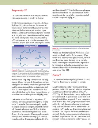 Interpretación o “lectura” del electrocardiograma

Segmento ST                                                           recti­fi­cación del ST. Este hallazgo se observa
                                                                      fre­cuen­temente en los pa­cien­tes con hiper­
Las dos características más importantes de                            ten­sión arterial esencial o con enfermedad
este segmento son el nivel y la forma:                                cardíaca isquémica (fig. 63).

El nivel: se compara con respecto a la línea
de base (TP). Normalmente debe estar al
mismo nivel de la línea TP, es decir isoe­léc­
trico, o sólo levemente por encima o por
debajo. En las derivaciones del plano frontal
se le per­mite una elevación normal de hasta
0.1 mV y en el plano horizontal hasta 0.2
mV., pero nunca se le permite una depresión
“nor­mal” mayor de 0.5 mV en ninguna de las

                                                                      Figura 64. Patrón de repolarización precoz en las derivaciones
                                                                      precordiales.

                                                                      Patrón de Repolarización Precoz: se carac­
                                                                      teriza por la elevación del segmento ST en
                                                                      una o más derivaciones precor­diales, la cual
                                                                      puede ser de hasta 4 mm y no se correla­
                                                                      ciona con ninguna anormalidad específica.
                                                                      Se considera un hallazgo normal y es más
                                                                      común observarlo en hombres jóvenes de
Figura 63. Segmento ST. Arriba centro: segmento ST normal             raza negra (fig. 64).
que inicia isoeléctrico y termina ligeramente ascendente. Arriba
izquierda: ST rectificado; arriba derecha: elevación del ST de con­
cavidad superior; abajo izquierda: depresión plana del ST; abajo
derecha: elevación del ST de convexidad superior.
                                                                      Onda T
deriva­cio­nes (fig. 63). La elevación del seg­                       Las tres características princi­pa­les de la onda
mento ST por encima de los valores nor­ma­                            T son la direc­ción, la forma y el voltaje.
les sugiere un evento coronario agudo en evo­
lu­ción o una pericarditis. La de­presión del                         La dirección: la onda T nor­malmente es
ST > 0.5 mV sugiere una isquemia de tipo                              positiva en DI, DII y de V3 a V6, es negativa
suben­docárdica (es la única isquemia que se                          en aVR y puede ser variable en DIII, aVL,
ma­ni­fiesta sobre el segmento ST) (fig. 63).                         aVF, V1 y V2. Pero existen ciertas reglas para
                                                                      la variabilidad: es positiva en aVL y aVF si el
La forma: normalmente el segmento ST                                  complejo QRS es mayor de 5 mm y negativa
termina en una curva imperceptible con la                             si es menor de 5 mm (en personas sin desvi­
onda T, no debe formar un ángulo agudo                                ación del eje). Es normalmente negativa en
ni seguir un curso completamente horizon­                             V1 y ocasionalmente en V2. Si la onda T es
tal. Es decir, el segmento ST debe iniciar                            positiva en V1 debe ser de menor voltaje que
isoeléc­trico y terminar ligeramente ascen­                           la onda T de V6 para ser consi­de­rada como
dente. Si el segmento ST es completamente                             normal. En las mujeres es normal encontrar
recto (como trazado con regla) se conoce                              ondas T negativas de V1 a V3 y no se sabe el
con el nombre de depresión plana del ST o                             porqué. En los ancianos la onda T puede ser

                                                                                                                                       37
 