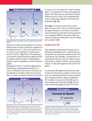 se conoce con el nombre de “onda T hipera­
                                                                     gu­da” y se presenta en la fase más aguda del
                                                                     infarto del miocardio en evolución. Se debe
                                                                     dife­ren­ciar de la onda T de la hiperka­lemia
                                                                     y de la sobrecarga diastó­lica del ventrículo
                                                                     izquier­do (fig. 66).

                                                                     El voltaje: el voltaje normal de la onda T
                                                                     debe ser menor de 5 mm en las derivaciones
                                                                     del plano frontal y de 10 mm en las deri­va­
                                                                     ciones del plano horizontal. En los pacientes
                                                                     con comple­jos QRS de muy alto voltaje las
                                                                     ondas T pueden ser hasta del 35% del voltaje
                                                                     del complejo QRS.
Figura 65. Patrón juvenil de la onda T en las derivaciones precor­
diales.
positiva en todas las precor­diales. En niños y                      Segmento QT
adolescentes la onda T puede ser negativa en
las derivaciones V1 a V4 y ser normal y esto                         Este segmento representa el tiempo que se
se conoce con el nombre de “patrón juve­                             demora la despo­larización y repola­riza­ción
nil de la onda T” (fig. 65). En los pacientes                        ventricular. Su duración normal es entre 320
con eventos cerebro­vasculares agudos (ECV)                          y 400 mseg. Sin embargo, su dura­ción se ve
se pue­­den observar ondas T hiper­agudas o                          afectada por factores como la edad, el sexo y
negativas que no significan evento coronario                         la frecuencia car­díaca. Debido a esto es me­jor
agudo.                                                               utilizar el valor del segmento QTc (QT corre­
La forma: la onda T normal es ligeramente                            gido).
redondeada y ligeramente asimétrica. La
onda T mellada en los niños es nor­­mal y en                         La corrección del segmento QT para las va­ria­
los adultos es un signo in­directo de pericar­                       ciones de la fre­cuencia cardíaca se hacen con
ditis. La onda T puntuda, simétrica y positiva                       base en la fórmula de Bazett. Bazett propuso
                                                                     que el seg­men­to QTc es igual al segmento
                                                                     QT medido en el paciente divi­di­do por la
                                                                     raíz cuadrada del intervalo RR (fig. 67). El
                                                                     valor normal del segmento QTc es de 400




Figura 66. Diferentes morfologías de la onda T. Arriba centro:
onda T normal, ligeramente redondeada y ligeramente asimétrica;      Figura 67. Fórmula de Bazett para corregir el Intervalo QT con
arriba izquierda: onda T negativa puntuda y simétrica sugestiva      respecto a la frecuencia cardíaca. Para esta fórmula se deben
de isquemia; arriba derecha: onda T hiperaguda; abajo izquierda:     utilizar valores en segundos. La raíz cuadrada del intervalo RR se
onda T negativa asimétrica sugestiva de sobrecarga y abajo dere­     refiere a la raíz cuadrada del valor en segundos que exista entre
cha: onda T mellada.                                                 dos ondas R consecutivas.

38
 