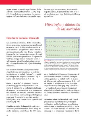 su­gestivas de estenosis significativa de la        hemorragia intra­craneana, tirotoxicosis,
arteria descendente anterior (ADA) (fig.            hiper­calcemia, hipokalemia y con el uso
69). Su voltaje se aumenta en los pa­cien­          de medicamentos tipo digital, quinidina y
tes con enfermedad cerebrovascular tipo             epinefrina.



                                                    Hipertrofia y dilatación
                                                           de las aurículas

Hipertrofia auricular izquierda

Las aurículas a diferencia de los ventrículos
tienen una escasa masa muscular por lo cual
cuando se habla de hipertrofia auri­cular se
hace referencia a la presencia de dilatación o
creci­miento auricular y no de una verdadera
hipertrofia. Las causas más comu­nes de creci­
miento auricular izquierdo son la hiper­trofia
ventricular iz­­quier­da de cualquier causa, la
valvulo­pa­tía mitral (insu­ficien­cia y este­no­   Figura 70. Note la presencia de onda P mitrale en las derivaciones
                                                    V3 a V5 y la presencia de onda P isodifásica con porción negativa
sis) y la valvulo­pa­tía aórtica (insuficiencia y   mayor de 40 mseg. de ancho y de 0.1 mV de profundidad en V1
estenosis).                                         y V2. En las deriva­cio­nes inferiores la onda P es de tipo Pulmo­
                                                    nale con una altura mayor de 0.25 mV. Todo lo anterior sumado
                                                    al hecho de que se observa hipertrofia ventricular derecha y un
Los criterios más utilizados para hacer el          ventrículo izquierdo pequeño constituye el diagnóstico de una
diagnóstico de creci­miento de la aurícula
izquierda son la onda P “Mitrale” y el aná­li­      especificidad del 80% para el diag­nós­tico de
sis de la porción negativa de la onda P y la        creci­miento auricular izquierdo. Si la por­
fuerza terminal de la onda P en V1.                 ción negativa de la onda P en V1 es me­nor
                                                    de 40 mseg. de ancho pero mayor de 0.1 mV
Onda P “Mitrale”: es una onda P ancha               de voltaje, la sensi­bi­li­dad es del 60% y la
(>110 mseg.) y mella­da (melladura >40              espe­ci­fi­ci­dad del 93% (fig. 70). En la tabla
mseg. de ancho). Es la onda típica de los pa­       1 se pueden observar los criterios para el
cientes con estenosis mitral pero no es exclu­      diagnós­tico de la dilatación auricular izquier­
siva de ellos. En realidad, cualquier paciente      da con su respectiva sensi­bi­li­dad y especifici­
con crecimiento auricular izquierdo la puede        dad.
presentar. Es un criterio con baja sensi­bi­
lidad (15%) pero con excelente especificidad        Fuerza terminal de la onda P en V1: es el
(100%) (fig. 70).                                   producto de la profundidad (voltaje) en
                                                    milímetros multiplicado por la anchura en
Porción negativa de la onda P en V1: cu­            segundos de la porción terminal de la onda
ando esta porción es mayor de 40 mseg. de           P en V1. Lo normal es que sea menor de 40
ancho tiene una sensibilidad del 83% y una          mm/seg. Si se obtiene un valor mayor de 40

40
 