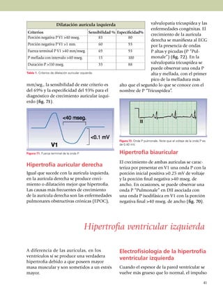 Dilatación aurícula izquierda                               valvulopatía tricuspídea y las
                                                                                  enfermedades congé­ni­tas. El
 Criterios                                        Sensibilidad % Especificidad%
                                                                                  crecimiento de la aurícula
 Porción negativa P V1 >40 mseg.	                      83	             80
                                                                                  derecha se mani­fiesta al ECG
 Porción negativa P V1 >1 mm.	                         60	             93         por la pre­sen­cia de ondas
 Fuerza terminal P V1 >40 mm/mseg.	                    69	             93         P altas y picudas (P “Pul­
 P mellada con intervalo >40 mseg.	                    15	             100        monale”) (fig. 72). En la
 Duración P >110 mseg.	                                33	             88         valvulo­pa­tía tricus­pí­dea se
                                                                                  puede obser­var una onda P
Tabla 1. Criterios de dilatación auricular izquierda.                             alta y me­lla­da, con el primer
                                                                                  pico de la melladura más
mm/seg., la sensibilidad de este criterio es                      alto que el segundo lo que se conoce con el
del 69% y la espe­ci­fi­cidad del 93% para el                     nombre de P “Tricuspídea”.
diagnós­tico de crecimiento auricular izqui­
erdo (fig. 71).




                                                          Figura 72. Onda P pulmonale. Note que el voltaje de la onda P es
                                                          de 0.40 mV.

Figura 71. Fuerza terminal de la onda P.                  Hipertrofia biauricular
                                                          El crecimiento de ambas aurí­culas se carac­
Hipertrofia auricular derecha                             teriza por presentar en V1 una onda P con la
Igual que sucede con la aurícula izquierda,               por­ción inicial positiva >0.25 mV de voltaje
en la aurícula de­recha se produce creci­                 y la por­ción final negativa >40 mseg. de
miento o dila­ta­ción mejor que hiper­trofia.             ancho. En ocasiones, se puede obser­var una
Las causas más frecuentes de creci­miento                 onda P “Pulmonale” en DII asociada con
de la aurícula derecha son las enfermedades               una onda P isodifásica en V1 con la por­ción
pulmo­na­res obstructivas crónicas (EPOC),                nega­tiva final >40 mseg. de ancho (fig. 70).




                                           Hipertrofia ventricular izquierda

A diferencia de las aurículas, en los                     Electrofisiología de la hipertrofia
ven­trículos sí se produce una verdadera
                                                          ventricular izquierda
hipertrofia debido a que poseen mayor
masa muscular y son some­ti­dos a un estrés               Cuando el espesor de la pared ventricular se
mayor.                                                    vuelve más grueso que lo normal, el impulso

                                                                                                                        41
 