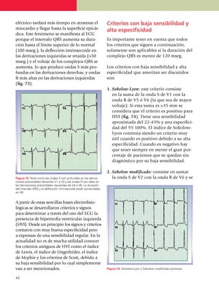 eléc­trico tardará más tiempo en atravesar el                      Criterios con baja sensi­bi­li­dad y
miocardio y llegar hasta la superficie epicár­                     alta especificidad
di­ca. Este fenómeno se manifiesta al ECG
porque el intervalo QRS aumenta su du­ra­                          Es importante tener en cuenta que todos
ción hasta el límite superior de lo normal                         los criterios que siguen a continuación,
(100 mseg.), la deflección intrinsecoide en                        sola­men­te son aplicables si la duración del
las deri­va­ciones izquierdas se retarda (>50                      complejo QRS es menor de 120 mseg.
mseg.) y el voltaje de los complejos QRS se
aumenta, lo que produce ondas S más pro­­                          Los criterios con baja sensibi­li­dad y alta
fundas en las derivaciones dere­chas, y ondas                      especificidad que ameritan ser discutidos
R más altas en las derivaciones izquierdas                         son:
(fig. 73).
                                                                   1.	Sokolow-Lyon: este criterio consiste
                                                                      en la suma de la onda S de V1 con la
                                                                      onda R de V5 ó V6 (la que sea de mayor
                                                                      voltaje). Si esta suma es >35 mm se
                                                                      consi­dera que el criterio es positivo para
                                                                      HVI (fig. 74). Tiene una sensibilidad
                                                                      aproxi­mada del 22-43% y una especi­fi­ci­
                                                                      dad del 95-100%. El ín­dice de Sokolow-
                                                                      Lyon continúa siendo un criterio muy
                                                                      útil cuando es positivo debido a su alta
                                                                      especi­fi­ci­dad. Cuan­do es negativo hay
                                                                      que tener siempre en mente el gran por­
                                                                      centaje de pa­cien­tes que se quedan sin
                                                                      diagnóstico por su baja sensibilidad.

                                                                   2.	Sokolow modificado: consiste en sumar
Figura 73. Note como las ondas S son profundas en las deriva­         la onda S de V2 con la onda R de V6 y se
ciones precordiales derechas V1 a V3 y las ondas R son altas en
las derivaciones precordiales izquierdas de V4 a V6. La duración
del intervalo QRS y la deflección intrinsecoide están aumentadas
en V6.


A partir de estas sencillas bases electrofisio­
ló­gicas se desarro­lla­ron criterios y signos
para de­ter­minar a través del uso del ECG la
pre­sencia de hipertrofia ventricular izquierda
(HVI). Desde un principio los signos y cri­terios
contaron con muy buena espe­ci­fi­ci­dad pero
a expensas de una sensibilidad re­gular. En la
actua­li­dad no es de mucha utilidad conocer
los criterios antiguos de HVI como el índice
de Lewis, el índice de Ungerleider, el índice
de Mcphie y los cri­te­rios de Scott, debido a
su baja sensi­bilidad por lo cual simplemente
van a ser mencionados.                                             Figura 74. Sokolow-Lyon y Sokolow modificado positivos.


42
 