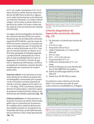en V1 con ondas S profundas en V6. En el
plano frontal se puede obser­var des­via­ción
del eje del QRS hacia la derecha y algunas
veces on­das Q prominentes en las deri­va­cio­
nes inferiores imi­tan­do a un infarto inferior
anti­guo. En los niños se puede obser­­var la
presencia de ondas S de mayor voltaje que              Figura 76. Patrón de bajo voltaje y rS de V1 a V6 con persistencia
                                                       de ondas S hasta V6 característico del paciente con enfisema
las ondas R en las tres derivaciones estándar          pulmonar.
(DI-DII-DIII).
                                                       Criterios diagnósticos de
Los signos electrocardiográficos de hiper­tro­         hipertrofia ventricular derecha
fia ventricular derecha (HVD) son menos                (fig. 77)
frecuentes que los de hiper­tro­fia ventri­cular
izquierda (HVI) debido a que las causas de             1.	 Eje desviado a la derecha por encima de
HVD son menos comunes y se necesita una                     +90º.
mayor sobrecarga para que el ventrículo de­­­          2.	 S V5-V6 ≥7 mm.
re­cho se vuelva dominante en el ECG. Para             3.	 Proporción S/R en V6 ≥1.
que el ventrículo derecho se observe en el             4.	 Onda P pulmonale >2.5 mm en DII-
ECG tiene que igualar al ven­trículo iz­quierdo             DIII-aVF.
y posteriormente sobre­pa­sarlo lo cual ex­            5.	 R V1 ≥7 mm.
pli­ca la baja sensi­bi­li­dad del ECG para el         6.	 R V1 + S V5 ó V6 ≥10 mm.
diag­nós­tico de la HVD y el hecho de que              7.	 Proporción R/S en V1 ≥1.
sólo se observen las HVD severas. La HVD se            8.	 Deflección intrinsecoide en V1 ≥35
acompa­ña de crecimiento auricular de­recho                 mseg.
mani­festado por la presencia de ondas P               9.	 Patrón de bloqueo de rama derecha del
pulmo­nales.                                                haz de His (BRDHH) incompleto.
                                                       10.	 Patrón de sobrecarga sistólica en DII-
Estenosis mitral: en los pacientes con este­                DIII-aVF.
no­sis mitral pura se observa un patrón elec­          11.	 Patrón S en DI-DII-DIII en niños.
trocardiográfico caracte­ri­za­do por la pre­sen­
cia de creci­mien­to auricular izquierdo (P            Los primeros cuatro criterios son los más
mitrale o porción negativa de la onda P en             útiles. Si se encuentra uno sólo de estos
V1 > 40 mseg., HVD, cre­ci­mien­to auricular           cuatro criterios la sensibilidad en el diag­nós­
derecho (P pulmonale) y ventrículo iz­quier­
do pequeño (ondas R de bajo voltaje en las
derivaciones pre­­cor­diales izquier­das) (fig. 70).

Enfisema pulmonar: en estos pacientes es
frecuente encontrar un patrón electro­car­dio­
gráfico que se caracteriza por la presencia
de complejos rS en todas las derivaciones
pre­­cor­diales (rotación en el sentido de las
                                                       Figura 77. Note la desviación marcada del eje a la derecha. Ondas
mane­ci­llas del reloj), eje del QRS desviado          R en V1 de 9 mm, onda S en V5 y V6 de 7 mm con pro­por­ción S/R
hacia la derecha y bajo voltaje ge­nera­li­zado        >1 en V6, patrón de sobrecarga sistólico en derivaciones dere­chas,
                                                       deflección intrinsecoide en V1 de 40 mseg y onda P pulmonale en
(fig. 76).                                             derivaciones inferiores. Este es un ECG típico de HVD.


46
 