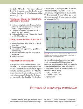 tico de la HVD es del 44% y la es­pe-cifi­cidad     nas oca­siones se puede presentar el “síndro­
del 83%. Si se en­cuen­tran dos de ellos la sen­    me de la onda S poco profunda” que se
si­bilidad disminuye al 18% y la espe­ci­fi­cidad   caracteriza por la presencia en la deri­va­ción
aumenta al 95%.                                     V1 de una onda S de bajo voltaje que se aso­
                                                    cia con una onda S de mucho mayor voltaje
Principales causas de hipertrofia                   en la derivación V2.
ventricular derecha
1.	 Lesiones congénitas: tetralogía de Fallot,
    estenosis valvular pulmonar y trans­po­si­
    ción de los grandes vasos.
2.	 Lesiones adquiridas: este­no­sis mitral e
    insuficiencia tricus­pídea.
3.	 Enfermedad Pulmonar Obstructiva Cró­ni­
    ca (EPOC): enfisema.

Otras causas de onda R alta en V1
1.	 Infarto agudo del miocardio de la pared
    posterior.
2.	 Síndrome de WPW.
3.	 Cardiomiopatía hipertrófica (por hiper­
    trofia septal).
4.	 Bloqueo fascicular septal o bloqueo de
                                                    Figura 78. Note la presencia de los criterios de HVI en precordia­
    Kulbertus.                                      les izquierdas combi­na­dos con la presencia de ondas R altas en
5.	 Variante normal.                                las derivaciones precordiales derechas.


                                                    La mejor forma de diagnosticar una hiper­
Hipertrofia biventricular
                                                    tro­fia biventricular al ECG, consiste en
Se diagnostica cuando se encuentran crite­          encon­trar los signos de crecimiento auricular
rios de HVI en las derivaciones precordiales        iquierdo asociados con uno cualquiera de
con eje desviado hacia la derecha en el plano       los siguientes signos (sensibilidad del 20% y
frontal o cuando hay criterios de HVI en las        especificidad del 94%):
precordiales izquierdas combi­nados con la          a. S/R ≥1 en V5 ó V6.
presencia de ondas R altas en las deriva­cio­       b. S en V5 ó V6 ≥7 mm.
nes pre­cordiales derechas (fig. 78). En al­gu­     c. Eje derecho.




                              Patrones de sobrecarga ventricular


Cuando el corazón tiene que bombear con­tra         en sístole y cuando la sangre sobre­llena un
una obstruc­ción se produce una sobrecarga          ventrículo la sobrecarga se produce en diás­

                                                                                                                    47
 