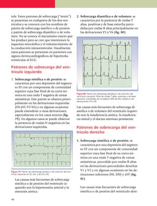 tole. Estos patrones de sobrecarga (“strain”)                     2.	Sobrecarga diastólica o de volumen: se
se pre­sentan en cualquiera de los dos ven­                          caracteriza por la pre­sencia de ondas T
trícu­­los y se conocen con los nombres de                           altas, positivas y de base estrecha prece­
patrón de sobrecarga sistólico o de presión                          didas por ondas R altas principal­men­te en
y patrón de sobrecarga dias­tólico o de volu­                        las derivaciones V5 y V6 (fig. 80).
men. No se conoce el mecanismo exacto que
los produce pero se cree que intervienen la
isquemia miocárdica y el enlentecimien­to de
la conducción intraventricular. Usual­mente,
estos patrones se presentan en pacientes con
signos electrocardiográficos de hipertrofia
ventricular al ECG.

Patrones de sobrecarga del ven­
trículo izquierdo
1.	 Sobrecarga sistólica o de presión: se
    caracteriza por una depre­sión del seg­men­
    to ST con un componente de con­vexidad
    superior cuya fase final de su curva ter­
                                                                  Figura 80. Patrón de sobrecarga diastólica o de volumen del
    mi­na en una onda T negativa de ramas                         ventrículo izquierdo. Note las ondas T altas, positivas y de base
    asi­­mé­tri­cas. Este patrón se observa princi­               estrecha, precedidas de complejos QRS de alto voltaje en las
                                                                  derivaciones V3 a V6.
    pal­mente en las deri­va­ciones izquierdas
    (DI-aVL-V5-V6) y en algunas ocasiones                         Las causas más frecuentes de sobrecarga di­
    puede extenderse a otras derivaciones,                        astólica o de volumen del ventrículo izquier­
    espe­cial­mente en los casos severos (fig.                    do son la insuficiencia aórtica, la insuficien­
    79). En algunos casos se puede observar                       cia mitral y el ductus arterioso persistente.
    la pre­sen­cia de ondas U ne­ga­tivas en las
    deriva­cio­nes izquierdas.                                    Patrones de sobrecarga del ven­
                                                                  trículo derecho

                                                                  1.	Sobrecarga sistólica o de presión: se
                                                                     caracteriza por una de­presión del seg­men­
                                                                     to ST con un componente de con­ve­xi­dad
                                                                     superior cuya fase final de su curva ter­
                                                                     mina en una onda T negativa de ramas
                                                                     asimétricas, precedido por ondas R altas
                                                                     en las deri­va­ciones precordiales derechas
Figura 79. Patrón de sobrecarga sistólico o de volumen del ven­
                                                                     V1 y V2 y en algunas oca­sio­nes en las de­
trículo izquierdo en DI, aVL y de V3 a V6.                           rivaciones infe­riores DII, DIII y aVF (fig.
	 Las causas más frecuentes de sobrecarga                            81).
  sistólica o de presión del ventrículo iz­
  quierdo son la hiper­ten­sión arterial y la                     	 Las causas más frecuentes de sobrecarga
  estenosis aórtica.                                                sistólica o de pre­­sión del ventrículo de­re­

48
 