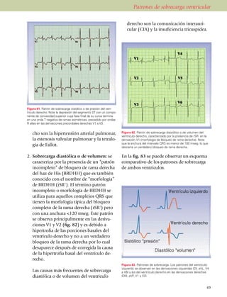 Patrones de sobrecarga ventricular

                                                                    	 de­recho son la comuni­cación inter­auri­
                                                                      cular (CIA) y la insuficiencia tricuspídea.




Figura 81. Patrón de sobrecarga sistólico o de presión del ven­­
trículo derecho. Note la depresión del segmento ST con un compo­
nente de convexidad superior cuya fase final de su curva termina
en una onda T negativa de ramas asimétricas, prece­dido por ondas
R altas en las derivaciones precordiales derechas V1 a V3.


   cho son la hipertensión arterial pulmonar,                       Figura 82. Patrón de sobrecarga diastólico o de volumen del
                                                                    ventrículo derecho, caracterizado por la presencia de rSR´ en la
   la este­no­sis valvular pulmonar y la tetra­lo­                  derivación V1 (morfología de bloqueo de rama derecha). Note
                                                                    que la anchura del intervalo QRS es menor de 100 mseg. lo que
   gía de Fallot.                                                   descarta un verdadero bloqueo de rama derecha.


2.	 Sobrecarga diastólica o de volumen: se                          En la fig. 83 se puede observar un esquema
    caracteriza por la presencia de un “patrón                      comparativo de los patrones de sobrecarga
    incompleto” de bloqueo de rama derecha                          de ambos ventrículos.
    del haz de His (BRDHH) que es también
    conocido con el nombre de “morfología”
    de BRDHH (rSR´). El término patrón
    in­completo o morfología de BRDHH se
    utiliza para aquellos complejos QRS que
    tienen la morfología típica del bloqueo
    completo de la rama derecha (rSR´) pero
    con una anchura <120 mseg. Este patrón
    se observa prin­ci­palmente en las deri­va­
    cio­nes V1 y V2 (fig. 82) y es debido a
    hiper­trofia de las por­cio­nes basales del
    ventrículo derecho y no a un verdadero
    bloqueo de la rama derecha por lo cual
    desaparece después de corregida la causa
    de la hipertrofia basal del ventrículo de­
    recho.
                                                                    Figura 83. Patrones de sobrecarga. Los patrones del ventrículo
                                                                    izquierdo se observan en las derivaciones izquierdas (DI, aVL, V4
	 Las causas más frecuentes de sobrecarga                           a V6) y los del ventrículo derecho en las derivaciones derechas
  diastólica o de volu­men del ventrículo                           (DIII, aVF, V1 y V2).


                                                                                                                                   49
 