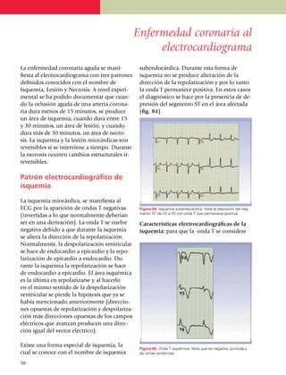 Enfermedad coronaria al
                                                         electrocardiograma
La enfermedad coronaria aguda se mani­               suben­docárdica. Durante esta forma de
fiesta al electrocar­dio­gra­ma con tres patrones    isquemia no se produce alteración de la
definidos conocidos con el nombre de                 dirección de la repolarización y por lo tanto
Isquemia, Lesión y Necrosis. A nivel experi­         la onda T permanece positiva. En estos casos
mental se ha podido documentar que cuan­             el diagnóstico se hace por la presencia de de­
do la oclusión aguda de una arteria coro­na­         presión del segmento ST en el área afectada
ria dura menos de 15 minutos, se produce             (fig. 84).
un área de isquemia; cuando dura entre 15
y 30 minutos, un área de lesión; y cuando
dura más de 30 minutos, un área de necro­
sis. La isque­mia y la lesión miocárdicas son
re­versibles si se interviene a tiempo. Durante
la necrosis ocurren cambios estruc­turales ir­
reversibles.

Patrón electrocardio­gráfico de
isquemia

La isquemia miocárdica, se manifiesta al
ECG por la aparición de ondas T negativas            Figura 84. Isquemia subendocárdica. Note la depresión del seg­
                                                     mento ST de V2 a V5 con onda T que permanece positiva.
(invertidas a lo que normal­mente deberían
ser en una derivación). La onda T se vuelve          Características electrocar­dio­gráficas de la
negativa debido a que durante la isquemia            isquemia: para que la onda T se considere
se altera la dirección de la repola­ri­zación.
Normalmente, la despola­ri­zación ventricular
se hace de endocardio a epicardio y la repo­
larización de epicardio a endocardio. Du­
rante la isque­mia la repolarización se hace
de endocardio a epicardio. El área isquémica
es la última en repola­rizarse y al hacerlo
en el mismo sentido de la despo­la­rización
ventricular se pierde la hipótesis que ya se
había mencionado anterior­mente (direccio­
nes opuestas de repolarización y despo­lariza­
ción más direcciones opuestas de los campos
eléctricos que avanzan producen una direc­
ción igual del vector eléctrico).

Existe una forma especial de isquemia, la
                                                     Figura 85. Onda T isquémica. Note que es negativa, puntuda y
cual se conoce con el nombre de isquemia             de ramas simétricas.

50
 