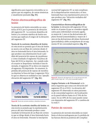 Enfermedad coronaria al electrocardiograma

significativa para isquemia miocárdica se re­                          normal del segmento ST, se está comple­tan­
quiere que sea negativa, de ramas simé­tri­cas                         do la despo­la­rización ventricular y el área
y usualmente puntuda (fig. 85).                                        lesionada hace una repolari­za­ción precoz lo
                                                                       que produce una “elevación verdadera del
Patrón electrocardio­gráfico de                                        seg­mento ST” (fig. 86).
lesión
                                                                       Características electrocardio­grá­ficas de
La presencia de lesión mio­cárdica se carac­                           la lesión: la elevación del segmento ST (se
te­riza al ECG por la presencia de elevación                           mide en el punto J) que se considera signifi­
del segmento ST. La corriente diastólica de                            cativa para enfermedad coronaria aguda,
le­sión y la corriente sistólica de lesión son                         es mayor de 1 mm en las deriva­ciones del
teorías que explican el origen de la elevación                         pla­no frontal (extremidades) y mayor de 2
del segmento ST.                                                       mm en las deri­va­ciones del plano horizontal
                                                                       (pre­cordiales) y debe acompa­ñarse de un seg­
Teoría de la corriente diastólica de lesión:                           mento ST de convexidad superior (fig. 87).
en esta teoría se postula que el área de lesión
se asocia con un flujo de corriente desde el
área no lesionada hacia el área lesio­na­da, lo
que produce una dis­minución local o pér­
di­da del potencial de reposo de membrana
y como resultado el segmento TQ (línea de
base del ECG) se deprime. Así, cuando todo
el corazón se despolarice incluida el área le­
sionada, el segmento ST se eleva con res­pec­to
al segmento TQ deprimido. En resumen, la
pérdida del potencial de reposo de membra­
na deprime la línea de base ó segmento TQ y
lo que se observa en realidad es una “pseudo
elevación del segmento ST” (fig. 86).                                  Figura 87. Elevación del segmento ST en las derivaciones del
                                                                       plano frontal mayor de 1 mm y de convexidad superior.


                                                                       Angina Variante o de Prinz­me­tal: es la
                                                                       única isque­mia que cursa con elevación del
                                                                       seg­mento ST en el ECG. La ele­va­ción del
                                                                       segmento ST obser­va­da en estos pacientes
                                                                       es de concavidad superior y de localización
                                                                       en la pared inferior hasta en el 78% de los
                                                                       casos. En un 40% de los casos puede cursar
Figura 86. Teoría de corriente sistólica y diastólica de lesión.
                                                                       con depresión del segmento ST o cambios de
                                                                       la onda T.
Teoría de la corriente sistólica de lesión: en
esta teoría se pos­tula que la repolarización                          Patrón de necrosis
precoz del área lesionada produce como
resultado la formación de un flujo de co­rrien­                        La presencia de necrosis miocárdica se ma­ni­
te que se dirige desde el área lesio­na­da hacia                       fiesta al electro­cardiograma por la pérdida de
el área no lesionada. Duran­te la ins­crip­ción                        las fuerzas eléctricas positivas del complejo

                                                                                                                                      51
 