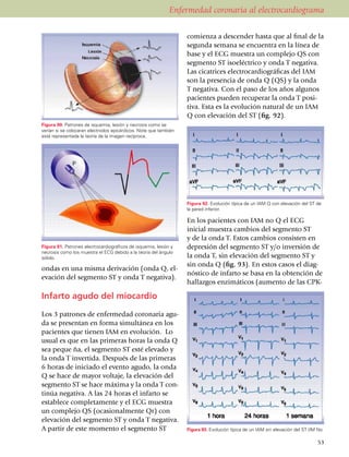 Enfermedad coronaria al electrocardiograma

                                                                  comien­za a descender hasta que al final de la
                                                                  segunda semana se en­cuen­tra en la línea de
                                                                  base y el ECG muestra un complejo QS con
                                                                  segmento ST iso­eléc­trico y onda T negativa.
                                                                  Las cicatrices electrocar­dio­grá­ficas del IAM
                                                                  son la presencia de onda Q (QS) y la onda
                                                                  T ne­ga­tiva. Con el paso de los años algunos
                                                                  pacientes pueden recuperar la onda T posi­
                                                                  tiva. Esta es la evolución natural de un IAM
                                                                  Q con elevación del ST (fig. 92).
Figura 90. Patrones de isquemia, lesión y necrosis como se
verían si se colocaran electrodos epicárdicos. Note que también
está representada la teoría de la imagen recíproca.




                                                                  Figura 92. Evolución típica de un IAM Q con elevación del ST de
                                                                  la pared inferior.

                                                                  En los pacientes con IAM no Q el ECG
                                                                  inicial muestra cambios del segmento ST
                                                                  y de la onda T. Estos cambios consisten en
Figura 91. Patrones electrocardiográficos de isquemia, lesión y   depresión del segmento ST y/o inversión de
necrosis como los muestra el ECG debido a la teoría del ángulo
sólido.                                                           la onda T, sin elevación del segmento ST y
                                                                  sin onda Q (fig. 93). En estos casos el diag­
ondas en una misma derivación (onda Q, el­
                                                                  nóstico de infarto se basa en la obtención de
evación del segmento ST y onda T negativa).
                                                                  hallazgos enzimáticos (au­men­to de las CPK-

Infarto agudo del miocardio
Los 3 patrones de enfermedad coronaria agu­
da se presentan en forma simultánea en los
pacientes que tienen IAM en evolución. Lo
usual es que en las primeras horas la onda Q
sea peque ña, el segmento ST esté elevado y
la onda T in­ver­tida. Después de las pri­me­ras
6 horas de iniciado el evento agu­do, la onda
Q se hace de mayor vol­taje, la elevación del
seg­mento ST se hace máxima y la onda T con­
ti­núa negativa. A las 24 horas el infarto se
esta­ble­ce comple­ta­mente y el ECG muestra
un complejo QS (oca­sional­mente Qr) con
ele­­­vación del segmen­to ST y onda T ne­gativa.
A partir de este mo­mento el segmento ST                          Figura 93. Evolución típica de un IAM sin elevación del ST (IM No

                                                                                                                                53
 