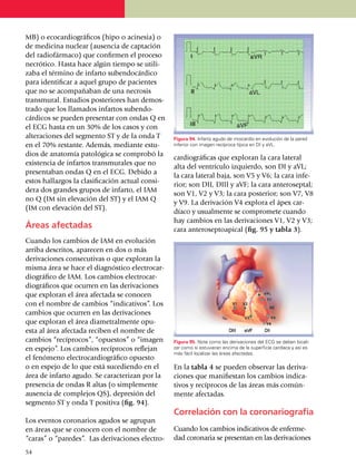 MB) o ecocardio­gráficos (hipo o acinesia) o
de medicina nuclear (ausencia de captación
del radiofármaco) que confirmen el proceso
ne­cró­tico. Hasta hace algún tiempo se uti­li­
zaba el término de infarto subendo­cár­dico
para identificar a aquel grupo de pa­cientes
que no se acompa­ñaban de una necrosis
transmural. Estudios posteriores han demos­
trado que los llamados infartos suben­do­
cárdicos se pueden presentar con ondas Q en
el ECG hasta en un 30% de los casos y con
alteraciones del segmento ST y de la onda T         Figura 94. Infarto agudo de miocardio en evolución de la pared
en el 70% restante. Además, mediante estu­          inferior con imagen recíproca típica en DI y aVL.

dios de anatomía pato­lógica se comprobó la
                                                    car­dio­gráficas que exploran la cara lateral
existencia de infartos trans­mu­rales que no
                                                    alta del ventrículo izquierdo, son DI y aVL;
presentaban ondas Q en el ECG. Debido a
                                                    la cara lateral baja, son V5 y V6; la cara infe­
estos hallazgos la clasificación actual consi­
                                                    rior; son DII, DIII y aVF; la cara ante­ro­septal;
dera dos grandes grupos de infarto, el IAM
                                                    son V1, V2 y V3; la cara posterior; son V7, V8
no Q (IM sin elevación del ST) y el IAM Q
                                                    y V9. La de­ri­vación V4 explora el ápex car­
(IM con elevación del ST).
                                                    díaco y usualmente se compromete cuan­do
                                                    hay cambios en las derivaciones V1, V2 y V3;
Áreas afectadas                                     cara antero­septo­apical (fig. 95 y tabla 3).
Cuando los cambios de IAM en evolución
arriba descritos, apa­recen en dos o más
deri­va­ciones consecutivas o que exploran la
misma área se hace el diagnóstico electrocar­
dio­grá­fico de IAM. Los cambios elec­trocar­
dio­gráficos que ocurren en las deriva­ciones
que exploran el área afectada se conocen
con el nombre de cambios “indi­ca­ti­vos”. Los
cambios que ocurren en las deri­va­ciones
que exploran el área diametralmente opu­
esta al área afec­ta­da reciben el nombre de
cambios “recí­pro­cos”, “opuestos” o “imagen        Figura 95. Note como las derivaciones del ECG se deben locali­
en espejo”. Los cambios recíprocos reflejan         zar como si estuvieran encima de la superficie cardíaca y así es
                                                    más fácil localizar las áreas afectadas.
el fenó­meno elec­tro­car­diográfico opuesto
o en espejo de lo que está sucediendo en el         En la tabla 4 se pueden observar las deriva­
área de infarto agudo. Se carac­terizan por la      ciones que mani­fiestan los cambios indica­
presencia de ondas R altas (o simplemente           tivos y recíprocos de las áreas más común­
ausencia de complejos QS), depresión del            mente afectadas.
segmento ST y onda T positiva (fig. 94).
                                                    Correlación con la coronariografía
Los eventos coronarios agudos se agrupan
en áreas que se conocen con el nombre de            Cuando los cambios indicativos de enferme­
“caras” o “paredes”. Las de­ri­va­ciones electro­   dad coronaria se presentan en las derivaciones
54
 