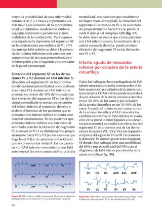 mayor la probabilidad de una enfermedad                             mortalidad, son pacientes que usualmente
coronaria de 2 ó 3 vasos y el pronóstico es                         no llegan vivos al hospital), la ele­vación del
más malo (por aumento de la morbi­mor­ta­                           segmento ST es menor en V1 y va aumen­tan­
lidad por arritmias, insu­fi­ciencia cardíaca,                      do pro­gresi­va­mente hacia V3 y se pierde la
isquemia re­cu­rrente o persistente y anor­                         onda R inicial del complejo QRS (fig. 97).
malidades de la con­ducción). Para algunos                          Se debe tener en cuenta que en los pacientes
investi­ga­dores la depresión del segmento ST                       con IAM inferior previo, la reoclusión de la
en las derivaciones pre­cor­dia­les de V1 a V3                      arteria coronaria derecha, puede producir
durante un IAM infe­­rior se debe a la presen­                      elevación del segmento ST en las derivacio­
cia de infartos inferiores más extensos con                         nes V1 y V2.
compromiso de las caras poste­rolaterales e
inferoseptales y no a isquemia concomitante                         Infarto agudo de miocardio
de la pared anteroseptal.
                                                                    inferior por oclusión de la arteria
Elevación del segmento ST en las deri­va­                           circunfleja
cio­nes V1 y V2 durante un IAM inferior: la
elevación del segmento ST en las pri­meras                          Todos los hallazgos electrocar­diográficos del IAM
dos derivaciones precordiales (ocasio­nal­men­                      inferior men­cio­nados arriba corres­pon­den al in­
te es hasta V5) durante un IAM inferior se                          farto ocasionado por oclusión de la arteria coro­
presenta en menos del 10% de los pacientes.                         naria derecha. El IAM inferior puede ser produ­ci­
Esta elevación del segmento ST en las deri­va­                      do por oclusión de la arteria coro­na­ria derecha
                                                                    en un 50-70% de los casos y por oclu­sión
ciones pre­cordiales se asocia con extensión
                                                                    de la arteria circun­fle­ja en un 30-50% de los
del infarto inferior al ventrículo derecho y
                                                                    casos. Cuan­do el infarto es por compro­­miso
se debe diferenciar de los pa­cientes que se                        de la arteria circun­fleja el ECG muestra los
presentan con infarto inferior e infarto ante­                      cambios indi­ca­tivos de IAM inferior en evo­lu­
roseptal conco­mi­tante. En los pacientes que                       ción en la pared inferior (iguales a los descri­
presentan infarto inferior con exten­sión al                        tos pre­via­mente) aso­cia­dos con elevación del
ven­trículo derecho la elevación del segmento                       segmento ST en al menos una de las deriva­
ST es mayor en V1 y va dis­minuyendo progre­                        cio­nes late­ra­les (aVL, V5 y V6) sin de­pre­sión
siva­mente hacia V2 y V3 (en los casos en que                       recíproca del segmento ST en DI. En oca­­­sio­nes
llega hasta V3) y no aparecen ondas Q sino                          la deri­vación DI también puede tener el seg­men­to
que se conservan las ondas R. En los pacien­                        ST ele­­vado. Este hallaz­go tiene una sensibi­li­dad
tes con IAM inferior concomitante con IAM                           del 80% y una especificidad del 90% para el
ante­ro­septal (es poco común debido a la alta                      diagnóstico de IAM inferior por oclusión de la
                                                                    arteria circunfleja (fig. 98).




Figura 97. IAM inferior e IAM anteroseptal. Note que la elevación   Figura 98. IAM inferior por oclusión de la arteria circunfleja. Note
del segmento ST es menor en V1 y va aumentando hacia V3.            la elevación del segmento ST en las derivaciones V5 y V6.

56
 