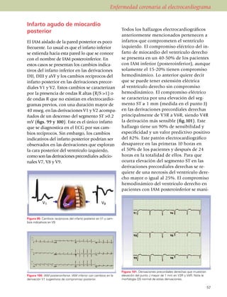 Enfermedad coronaria al electrocardiograma


Infarto agudo de miocardio
posterior                                                          Todos los hallazgos electrocar­diográficos
                                                                   anteriormente men­cionados pertenecen a
El IAM aislado de la pared posterior es poco                       infartos que comprometen el ven­trículo
frecuente. Lo usual es que el infarto inferior                     iz­quierdo. El compro­miso eléctrico del in­
se extienda hacia esta pared lo que se conoce                      farto de miocardio del ventrículo derecho
con el nombre de IAM posteroinferior. En                           se pre­senta en un 40-50% de los pacientes
estos casos se presentan los cambios indica­                       con IAM inferior (posteroinferior), aunque
ti­vos del infarto inferior en las deri­vaciones                   so­la­mente el 15-20% tienen compro­miso
DII, DIII y aVF y los cambios recíprocos del                       hemodinámico. Lo anterior quiere decir
infarto posterior en las deriva­ciones precor­                     que se puede tener extensión eléctrica
diales V1 y V2. Estos cambios se caracterizan                      al ven­trículo derecho sin compro­miso
por la presencia de ondas R altas (R/S >1) o                       hemodi­ná­mico. El compromiso eléctrico
de ondas R que no existían en electro­car­dio­                     se carac­teriza por una elevación del seg­
gramas previos, con una dura­ción mayor de                         mento ST ≥ 1 mm (medida en el punto J)
40 mseg. en las derivaciones V1 y V2 acompa­                       en las derivaciones precordiales derechas
ñados de un descenso del segmento ST >0.2                          principal­mente de V3R a V6R, siendo V4R
mV (figs. 99 y 100). Este es el único infarto                      la derivación más sensi­ble (fig.101). Este
que se diagnostica en el ECG por sus cam­                          hallazgo tiene un 90% de sensibilidad y
bios recíprocos. Sin embargo, los cambios                          espe­cificidad y un valor pre­dictivo positivo
indica­ti­vos del infarto posterior podrían ser                    del 82%. Este patrón elec­tro­cardiográfico
observa­dos en las deriva­cio­nes que exploran                     desaparece en las pri­me­ras 10 horas en
la cara posterior del ventrículo izquierdo,                        el 50% de los pacientes y después de 24
como son las derivaciones pre­cor­diales adicio­                   horas en la totalidad de ellos. Para que
nales V7, V8 y V9.                                                 ocurra elevación del segmento ST en las
                                                                   deri­va­ciones precordiales derechas se re­­
Infarto del ventriculo derecho                                     quie­re de una necrosis del ventrículo dere­
                                                                   cho mayor o igual al 25%. El compro­mi­so
                                                                   he­mo­­di­námico del ventrículo derecho en
                                                                   pacientes con IAM poste­ro­inferior se ma­ni­




Figura 99. Cambios recíprocos del infarto posterior en V1 y cam­
bios indicativos en V9.




                                                                   Figura 101. Derivaciones precordiales derechas que muestran
Figura 100. IAM posteroinferior. IAM inferior con cambios en la    elevación del punto J mayor de 1 mm en V3R y V4R. Note la
derivación V1 sugestivos de compromiso posterior.                  morfología QS normal de estas derivaciones.

                                                                                                                                 57
 