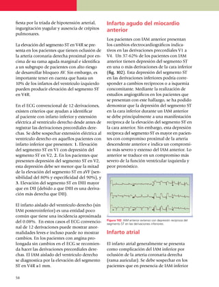 fiesta por la tríada de hipotensión arterial,      Infarto agudo del miocardio
ingurgitación yugular y ausencia de crépitos       anterior
pulmonares.
                                                   Los pacientes con IAM anterior presentan
La elevación del segmento ST en V4R se pre­        los cambios electro­cardiográficos indica­
senta en los pacientes que tienen oclu­sión de     tivos en las derivaciones precordiales V1 a
la arteria coronaria derecha proximal por en­      V4. Un 37-62% de los pacientes con IAM
cima de su rama aguda marginal e iden­ti­fi­ca     anterior tienen depresión del segmento ST
a un subgrupo de pacientes con alto riesgo         en una o más de­rivaciones de la cara inferior
de desarrollar bloqueo AV. Sin embar­go, es        (fig. 102). Esta depresión del segmento ST
importante tener en cuenta que hasta un            en las derivaciones inferiores podría corre­
10% de los infartos del ventrículo izquierdo       sponder a cambios recí­pro­cos o a isquemia
pueden producir elevación del segmento ST          con­co­mitante. Median­te la realización de
en V4R.                                            estudios angiográficos en los pacientes que
                                                   se pre­sen­tan con este hallazgo, se ha podido
En el ECG convencional de 12 derivaciones,         demos­trar que la depresión del segmento ST
existen criterios que ayudan a identificar         en la cara inferior durante un IAM anterior
al paciente con infarto inferior y extensión       se debe principalmente a una mani­fes­tación
eléctrica al ventrículo derecho desde antes de     recíproca de la elevación del segmento ST en
registrar las derivaciones precordiales dere­      la cara anterior. Sin embargo, esta depresión
chas. Se debe sospechar extensión eléctrica al     recíproca del segmento ST es mayor en pa­­cien­
ventrículo derecho en aquellos pacientes con       tes con compromiso proximal de la arteria
infarto inferior que pre­sen­ten: 1. Elevación     descen­dente anterior e indica un compro­mi­
del segmento ST en V1 con depresión del            so más severo y extenso del IAM anterior. Lo
segmento ST en V2, 2. En los pacientes que         anterior se traduce en un compromiso más
presenten de­pre­sión del segmento ST en V2,       severo de la función ventricular izquierda y
esta depresión debe ser menor que la mitad         peor pronóstico.
de la elevación del segmento ST en aVF (sen­
si­bi­li­dad del 80% y especificidad del 90%), y
3. Elevación del segmento ST en DIII mayor
que en DII (debido a que DIII es una de­ri­va­
ción más derecha que DII).

El infarto aislado del ventrículo derecho (sin
IAM poste­roin­fe­rior) es una entidad poco
común que tiene una inci­den­cia aproximada
                                                   Figura 102. IAM anterior extenso con depresión recíproca del
del 0.08%. En estos casos el ECG conven­cio­       segmento ST en las derivaciones inferiores.
nal de 12 derivaciones puede mostrar anor­
malidades leves e incluso puede no mostrar         Infarto atrial
cambios. En los pacientes con angina pro­
longada sin cambios en el ECG se reco­mien­        El infarto atrial generalmente se presenta
da hacer las derivaciones precordiales de­re­      como complicación del IAM inferior por
chas. El IAM aislado del ventrículo derecho        oclusión de la arteria coronaria derecha
se diag­nos­tica por la elevación del segmento     (rama auricular). Se debe sospechar en los
ST en V4R ≥1 mm.                                   pacientes que en presencia de IAM inferior

58
 