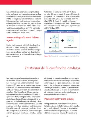 Las arritmias de reperfusión se presentan          Criterios: 1. Complejo QRS en DIII que
principalmente en los pacientes que reciben        termine 20 mseg. o más des­pués del comple­
trombolisis como parte del tratamiento del         jo QRS de DI. Este criterio tiene una sensi­bi­
IAM y son signos premonitorios de trombo­          lidad del 53% y una espe­cificidad del 97%
lisis exitosa. Los pacientes con trombolisis       (fig. 105). 2. Onda Q en aVF ≥40 mseg.
exitosa presentan extrasístoles ventriculares      su­mada al criterio anterior. Este criterio tiene
en aproxima­da­mente un 100%, ritmo idio­          una sensibilidad del 73% y una especi­fi­cidad
ven­tri­cular acelerado en un 90% (arrit­mia       del 95% (fig. 105).
muy característica de la reperfusión) y ta­qui­
cardia ventricular en un 25%.

Vectocardiografía en el infarto
agudo
En los pacientes con IAM inferior, la apli­ca­
ción de la vecto­cardiografía ha permitido
encontrar nuevos criterios electrocar­diográ­
ficos que ayu­dan a realizar un diagnóstico
correcto cuando se utilizan electrocar­diógra­
                                                   Figura 105. Aplicación de la vectocardiografía en el IAM inferior.
fos de 3 canales.




                        Trastornos de la conducción cardíaca

Los trastornos de la conducción cardíaca           cículos de la rama izquierda se cono­cen con
se conocen con el nombre de bloqueos.              el nombre de hemiblo­queos que pue­den ser
Los bloqueos son una interrupción en el            antero­superior o posteroinferior de acuerdo
impul­so eléctrico que se puede presentar en       con el fascículo que se encuen­tre bloqueado.
di­fe­rentes sitios del sistema de con­ducción     Si el impulso se bloquea en la porción más
car­día­co y de acuerdo con el sitio reciben su    distal del Purkinje, se conoce con el nombre
nombre. Si el impulso se bloquea a nivel           de bloqueo intraventricular o defecto de la
del nodo sinusal recibe el nombre de blo­          conducción intramiocárdico.
queo sinoatrial, si se presenta a nivel de las
aurí­cu­las se llama bloqueo intraatrial, si se    Pausa sinusal y paro sinusal
pre­sen­ta a nivel del nodo AV o haz de His se
llama bloqueo auriculoventricular o AV, si se      Una pausa sinusal es el resul­ta­do de una
pre­­senta a nivel de las ramas ventriculares se   falla transitoria en la formación del impulso
llama bloqueo de rama que puede ser de­re­         en el nodo sinusal. Cuando la inac­­ti­vidad
cho o izquierdo de acuerdo con la rama que         del nodo sinusal es prolongada se utiliza
esté bloqueada, y si se hace a nivel de los fas­   el tér­mi­no de paro sinusal. No existe una
60
 