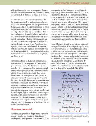 Trastornos de la conducción cardíaca

definición precisa para separar estas dos en­          conven­cional. Los bloqueos sinoa­triales de
tidades. En cualquiera de los dos casos, no se         segundo grado se manifiestan en el ECG por
observa onda P durante la pausa o el paro.             la ausencia de onda P y por consiguiente de
                                                       todo un complejo (P-QRS-T). La ausencia de
La pausa sinusal debe ser diferenciada del             onda P puede ser debida a una falla del nodo
bloqueo sinoatrial, la arritmia sinusal mar­           sinusal para generar el impulso, falla en que
ca­da y de los complejos atriales pre­ma­turos         el impulso active la aurícula (estí­mu­lo inade­
bloquea­dos. En el bloqueo sinoatrial el ciclo         cuado) o falla de la aurícula para responder
largo es un múltiplo del intervalo PP básico,          al impulso (parálisis auricular). En la prácti­
este tipo de relación no es posible de demos­          ca, sola-mente el segundo meca­nis­mo rep­
trar en la pausa sinusal. En la arritmia sinu­         resenta los verdaderos bloqueos sinoatriales
sal, el enlen­tecimiento del intervalo PP usual­       aunque es imposible determinar cuál es el
mente es gradual y fásico. En los comple­jos           mecanismo responsable mediante el ECG.
atriales prematuros bloqueados, a me­nudo
se puede detectar una onda P ectópica blo­             En el bloqueo sinoatrial de primer grado, el
queada distorsionando la onda T previa o               tiempo de conducción está prolongado pero
la línea de base. En algunas ocasiones no es           hay una respuesta 1:1. En el bloqueo sinoa­
fácil ver la onda P del complejo atrial pre­ma­        trial de segundo grado, algunos de los impul­
turo bloqueado y esto dificulta el diagnós­ti­         sos sinusales fallan en capturar (activar) la
co diferencial.                                        aurícula. En el bloqueo sinoatrial completo
                                                       o de tercer grado hay una falla completa en
Dependiendo de la duración de la inac­ti­vi­           la conducción sinoatrial. La existencia de
dad sinusal, la pausa puede ser terminada              estos defectos de la conducción sinoatrial
por un latido sinusal o de la unión o ven­             solamente puede ser inferida indirec­tamente
tricular. Si el paro sinusal es prolongado, el         de la actividad de la onda P (fig. 106).
ritmo de escape puede ser un ritmo idiojun­
cional lento o idio­ven­tricular. Bajo tales
circuns­tan­cias, es imposible determinar si
el mecanismo subyacente es paro sinusal o
bloqueo sinoa­trial. Las pausas sinu­sales oca­­sio­
nalmente se pueden observar en indi­vi­duos
nor­ma­les con aumento del tono vagal o con
hipersensibilidad del seno carotídeo. Las
pausas sinusales o el paro sinusal pue­den ser
causa­dos por digital, quinidina y otros agen­
tes antiarrítmicos o me­dicaciones antihiper­
tensivas. En los pacientes con infar­to agudo
del miocardio las pausas sinusales o el paro
sinusal pueden observarse princi­pal­mente en
los infartos inferiores.

Bloqueo sinoatrial
Este bloqueo puede ser de primero, segundo
                                                       Figura 106. Bloqueos sinoatriales. Las marcas en rojo correspon­
o tercer grado. Los bloqueos de pri­me­ro y            den a los impulsos sinusales que no pueden ser vistos en el ECG
tercer grado no se pueden observar en el ECG           convencional. Ver texto para la explicación.

                                                                                                                    61
 