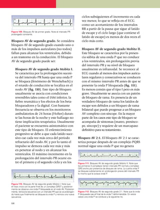 ciclos subsiguientes el incremento es cada
                                                                             vez menor, lo que se refleja en el ECG
                                                                             como un acor­tamiento de los inter­va­los
                                                                             RR a partir de la pausa que sigue al latido
Figura 109. Bloqueo AV de primer grado. Note el intervalo PR
prolongado cons­tante.
                                                                             de escape y el ciclo largo (que con­tiene el
                                                                             latido de escape) es menos de dos veces el
Bloqueo AV de segundo grado. Se con­si­de­ra                                 ciclo más corto.
bloqueo AV de segundo grado cuando uno o
más de los impulsos auriculares (no todos)                                	 Bloqueo AV de segundo grado Mobitz II.
fallan para alcanzar los ventrículos, debido                                Este bloqueo se caracteriza por la pre­sen­
a un tras­torno en la conducción. El bloqueo                                cia súbita de una onda P que no conduce
AV de segundo grado puede ser:                                              a los ventrículos, sin pro­lon­gación previa
                                                                            del intervalo PR y su nivel de bloqueo
	 Bloqueo AV de segundo grado Mobitz I.                                     usualmente es infranodal. Se reconoce al
  Se caracteriza por la prolon­gación suce­si­                              ECG cuando al menos dos impulsos au­ri­cu­
  va del intervalo PR hasta que una onda P                                  lares regulares y consecu­ti­vos se conducen
  se bloquea (fenómeno de Wenckebach) y                                     con el mismo intervalo PR antes de que se
  el retardo de con­ducción se localiza en el                               presente la onda P bloqueada (fig. 111).
  nodo AV (fig. 110). Este tipo de bloqueo                                  Es menos común que el tipo I pero es más
  usual­mente se asocia con condiciones                                     grave. Usual­mente se asocia con un patrón
  reversibles tales como el IAM inferior, la                                de bloqueo de rama. En pre­sencia de un
  fiebre reumática y los efectos de los beta­                               verda­dero bloqueo de rama los latidos de
  blo­queadores y la digital. Con bastante                                  escape son debi­dos a un bloqueo de rama
  fre­cuencia se observa en los monitoreos                                  bilateral que puede pro­gre­sar a un bloqueo
  ambulatorios de 24 horas (Holter) duran­                                  AV comple­to con síncope. En la mayor
  te las horas de la noche y este hallazgo no                               parte de los casos este tipo de blo­queo se
  tiene implica­ción terapéutica. Usual­men­te                              acompa­ña de sín­tomas (mareo, pre­sín­co­
  el paciente se encuen­tra asinto­má­tico con                              pe, síncope) y requiere de un marca­paso
  este tipo de bloqueo. El enlen­teci­miento                                definitivo para su trata­mien­to.
  progresivo se debe a que cada latido suce­
  sivo cae cada vez más cerca del período                                 Bloqueo AV 2:1. El bloqueo AV 2:1 se carac­
  refractario del nodo AV, y por lo tanto el                              teriza porque después de un complejo PQRS
  impulso se demora cada vez más y más                                    normal sigue una onda P que no genera
  en penetrar al nodo y en alcanzar los
  ventrículos. El máximo incremento en la
  prolon­ga­ción del intervalo PR ocurre en­
  tre el primero y el segun­do ciclo y en los                             Figura 111. Bloqueo AV de segundo grado Mobitz II. Note que
                                                                          los primeros 3 complejos tienen intervalo PR normal y complejo
                                                                          QRS ancho por presencia de bloqueo de rama. La cuarta onda P
                                                                          se bloquea súbitamente sin prolongación previa del intervalo PR
                                                                          lo mismo que la octava onda P.



Figura 110. Bloqueo AV de segundo grado Mobitz I. Note que
el trazo inicia con la parte final de un complejo QRST y poste­rior­
men­te se observa una onda P bloqueada en el nodo AV. Poste­rior­
mente, reinicia la secuencia con un intervalo PR que se va pro­lon­gan­   Figura 112. Bloqueo AV de segundo grado 2:1. Note que la onda
do hasta que finalmente se bloquea la onda P y reinicia una nueva         P bloqueada cae al final de la onda T deformándola. En estos
secuencia.                                                                casos una onda P se conduce y la siguiente no.


64
 