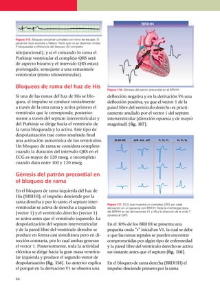 Figura 115. Bloqueo sinoatrial completo sin ritmo de escape. El
paciente hace asistolia y fallece. Note que no se observan ondas
P bloqueadas a diferencia del bloqueo AV completo.

idio­juncional), y si el coman­do lo toma el
Purkinje ventricular el comple­jo QRS será
de aspecto bizarro y el intervalo QRS estará
prolongado, semejante a una extrasístole
ventricular (ritmo idioventricular).

Bloqueos de rama del haz de His                                    Figura 116. Génesis del patrón precordial en el BRIHH.

Si una de las ramas del haz de His se blo­                         deflección negativa y en la derivación V6 una
quea, el impulso se conduce inicialmente                           deflección positiva, ya que el vector 1 de la
a través de la otra rama y activa primero el                       pared libre del ventrículo de­recho es prácti­
ventrículo que le corres­pon­de, posterior­                        camente anu­lado por el vector 1 del septum
men­te a través del septum interventricular y                      interventricular (dirección opuesta y de mayor
del Purkinje se dirige hacia el ventrículo de                      magnitud) (fig. 117).
la rama blo­quea­da y lo activa. Este tipo de
despolarización trae como resultado final
una activación asincrónica de los ventrículos.
Un bloqueo de rama se consi­dera completo
cuando la duración del intervalo QRS en el
ECG es mayor de 120 mseg. e incompleto
cuando dura entre 100 y 120 mseg.

Génesis del patrón precordial en
el bloqueo de rama
En el bloqueo de rama izquier­da del haz de
His (BRIHH), el impulso desciende por la
rama derecha y por lo tanto el septum inter­
                                                                   Figura 117. ECG que muestra un complejo QRS por cada
ventricular se activa de de­recha a izquierda                      deriva­ción en un paciente con BRIHH. Note la morfología típica
                                                                   del BRIHH en las derivaciones V1 y V6 y la dirección de la onda T
(vector 1) y el ventrículo derecho (vector 1)                      opuesta al QRS.
se activa antes que el ventrículo izquierdo. La
despolarización del septum interventricular                        En el 30% de los BRIHH se presenta una
y de la pared libre del ventrículo derecho se                      pequeña onda “r” inicial en V1, la cual se debe
produce en forma casi simultánea pero en di­                       a que las ramas septales se pueden encontrar
rección contraria, por lo cual ambas ge­ne­ran                     compro­me­tidas por algún tipo de enfer­medad
el vector 1. Posteriormente, toda la ac­ti­­vi­dad                 y la pared libre del ventrículo derecho se activa
eléctrica se dirige hacia la gran masa ventricu­                   un instante antes que el septum (fig. 116).
lar izquierda y produce el segundo vector de
despolarización (fig. 116). Lo an­te­rior explica                  En el bloqueo de rama derecha (BRDHH) el
el porqué en la deriva­ción V1 se observa una                      impulso descien­de primero por la rama

66
 