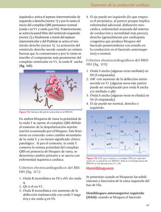 Trastornos de la conducción cardíaca

izquierda y activa el septum interventricular de         4.	 El eje puede ser izquierdo (lo que empeo­
izquierda a derecha (vector 1) y por lo tanto el             ra el pro­nós­tico, al parecer porque impli­ca
inicio del complejo QRS permanece normal                     enfermedad adi­cio­nal, dis­fun­ción mio­
(onda r en V1 y onda q en V6). Posterior­mente,              cárdica, enfermedad avanzada del sistema
se activa la pared libre del ventrículo izquierdo            de conducción y mor­talidad más precoz),
(vector 2) y finalmente a través del septum                  derecho (gene­ral­mente por car­diopatía
interventricular y del Purkinje se activa el ven­            con­gestiva que produce blo­queo del
trículo derecho (vector 3). La activación del                fascículo posteroinferior con retardo en
ventrículo derecho sucede cuando no existen                  la conducción en el fascículo anterosupe­
fuerzas que la contrarresten y por lo tanto se               rior) o normal.
inscribe el componente más prominente del
complejo ventricular en V1, la onda R´ ancha             Criterios electrocardio­gráficos del BRD-
(fig. 118).                                              HH (fig. 119):
                                                         1.	 Onda S ancha (algunas veces mellada) en
                                                             DI (S empastada).
                                                         2.	 rSR´ con aumento de la deflección intrin­
                                                             secoide en V1 (algunas veces este patrón
                                                             puede ser reempla­zado por onda R ancha
                                                             y/o mellada o qR)
                                                         3.	 Onda S ancha (algunas veces m ellada) en
                                                             V6 (S empastada).
                                                         4.	 El eje puede ser normal, derecho o
                                                         	 izquierdo.
Figura 118. Génesis del patrón precordial en el BRDHH.


En ambos bloqueos de rama la polaridad de
la onda T se opone al complejo QRS debido
al trastorno de la despola­riza­ción-repolar­
ización ocasionado por el bloqueo. Este fenó­
meno es co­nocido como cambio secun­dario
de la onda T, y no tienen significado clínico
patológico. Si por el contrario, la onda T
conserva la misma polaridad del complejo
QRS en presencia de bloqueo de rama, se
denomina cambio pri­ma­rio y se asocia con
                                                         Figura 119. ECG que muestra un complejo QRS por cada deri­
enfermedad isquémica cardíaca.                           vación en un paciente con BRDHH. Note la morfología típica del
                                                         BRDHH en las derivaciones V1 y V6.

Criterios electro­cardio­gráficos del BRI-               Hemibloqueos
HH (fig. 117):
1.	 Onda R monofásica en DI y aVL sin onda               Se presentan cuando se blo­quean las subdi­
    q.                                                   visiones o fascículos de la rama izquierda del
2.	 QS ó rS en V1.                                       haz de His.
3.	 Onda R monofásica con aumento de la
    deflección intrin­se­coide con onda T nega­          Hemibloqueo anterosuperior izquierdo
    tiva y sin onda q en V6.                             (HASI): cuando se bloquea el fascículo

                                                                                                                      67
 