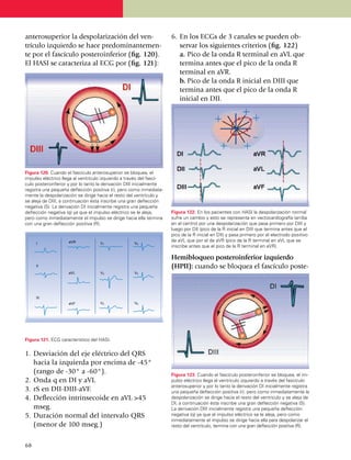 antero­superior la despolarización del ven­                            6.	 En los ECGs de 3 canales se pueden ob­
trículo izquierdo se hace predominan­te­men­                               servar los siguien­tes criterios (fig. 122)
te por el fascículo posteroinferior (fig. 120).                        	 a.	Pico de la onda R terminal en aVL que
El HASI se caracteriza al ECG por (fig. 121):                              termina antes que el pico de la onda R
                                                                           terminal en aVR.
                                                                       	 b.	Pico de la onda R inicial en DIII que
                                                                           termina antes que el pico de la onda R
                                                                           inicial en DII.




Figura 120. Cuando el fascículo anterosuperior se bloquea, el
impulso eléctrico llega al ventrículo izquierdo a través del fascí­
culo poste­roinferior y por lo tanto la derivación DIII inicialmente
registra una pequeña deflección positiva (r), pero como inmediata­
mente la des­po­larización se dirige hacia el resto del ventrículo y
se aleja de DIII, a con­tinuación ésta inscribe una gran deflección
negativa (S). La de­rivación DI inicialmente registra una pequeña
deflección negativa (q) ya que el impulso eléctrico se le aleja,       Figura 122. En los pacientes con HASI la despolarización normal
pero como inmediatamente el impulso se dirige hacia ella termina       sufre un cambio y esto se representa en vectocardiografía (arriba
con una gran deflección positiva (R).                                  en el centro) por una despola­riza­ción que pasa primero por DIII y
                                                                       luego por DII (pico de la R inicial en DIII que termina antes que el
                                                                       pico de la R inicial en DII) y pasa primero por el electrodo positivo
                     aVR                                               de aVL que por el de aVR (pico de la R terminal en aVL que se
     I                               V1              V4
                                                                       inscribe antes que el pico de la R terminal en aVR).

                                                                       Hemibloqueo posteroinferior izquierdo
     II                                                                (HPII): cuando se blo­quea el fascículo poste­
                     aVL             V2              V5




     III
                     aVF             V3              V6




Figura 121. ECG característico del HASI.


1.	Desviación del eje eléctrico del QRS
   hacia la izquierda por encima de -45°
   (rango de -30° a -60°).                                             Figura 123. Cuando el fascículo posteroinferior se bloquea, el im­
2.	Onda q en DI y aVL                                                  pulso eléctrico llega al ventrículo izquierdo a través del fascículo
                                                                       antero­su­perior y por lo tanto la derivación DI inicialmente registra
3.	rS en DII-DIII-aVF.                                                 una pequeña deflección positiva (r), pero como inmediatamente la
4.	Deflección intrinsecoide en aVL >45                                 despolarización se dirige hacia el resto del ventrículo y se aleja de
                                                                       DI, a continuación ésta inscribe una gran deflección negativa (S).
   mseg.                                                               La derivación DIII inicialmente registra una pequeña deflección
5.	Duración normal del intervalo QRS                                   negativa (q) ya que el impulso eléctrico se le aleja, pero como
                                                                       inmediatamente el impulso se dirige hacia ella para despolarizar el
   (menor de 100 mseg.)                                                resto del ven­trículo, termina con una gran deflección positiva (R).



68
 