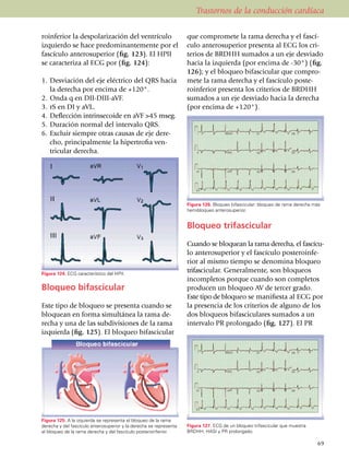 Trastornos de la conducción cardíaca

ro­infe­rior la despolarización del ven­trícu­lo                    que compro­mete la rama derecha y el fascí­
izquierdo se hace predominan­te­­mente por el                       culo anterosuperior presenta al ECG los cri­
fascículo antero­superior (fig. 123). El HPII                       terios de BRDHH sumados a un eje des­viado
se caracteriza al ECG por (fig. 124):                               hacia la izquierda (por encima de -30°) (fig.
                                                                    126); y el bloqueo bifascicular que compro­
1.	 Desviación del eje eléctrico del QRS hacia                      mete la rama derecha y el fascículo poste­
    la derecha por encima de +120°.                                 roinferior presenta los criterios de BRDHH
2.	 Onda q en DII-DIII-aVF.                                         sumados a un eje desviado hacia la derecha
3.	 rS en DI y aVL.                                                 (por encima de +120°).
4.	 Deflección intrinsecoide en aVF >45 mseg.
5.	 Duración normal del intervalo QRS.
6.	 Excluir siempre otras causas de eje dere­
    cho, princi­pal­mente la hipertrofia ven­
    tricular derecha.




                                                                    Figura 126. Bloqueo bifascicular: bloqueo de rama derecha más
                                                                    hemibloqueo anterosuperior.


                                                                    Bloqueo trifascicular

                                                                    Cuando se bloquean la rama derecha, el fascícu­
                                                                    lo antero­su­perior y el fascículo poste­roin­fe­
                                                                    rior al mismo tiempo se deno­mina bloqueo
Figura 124. ECG característico del HPII.
                                                                    trifas­ci­cular. Generalmente, son bloqueos
                                                                    incompletos porque cuando son completos
Bloqueo bifascicular                                                producen un bloqueo AV de tercer grado.
                                                                    Este tipo de blo­queo se manifiesta al ECG por
Este tipo de bloqueo se presenta cuando se                          la presencia de los criterios de alguno de los
bloquean en forma simultánea la rama de­                            dos bloqueos bifasciculares sumados a un
re­cha y una de las subdivisiones de la rama                        intervalo PR prolongado (fig. 127). El PR
izquierda (fig. 125). El bloqueo bifa­sci­cular




Figura 125. A la izquierda se representa el bloqueo de la rama
derecha y del fascículo anterosuperior y la derecha se representa   Figura 127. ECG de un bloqueo trifasci­cu­lar que muestra
el bloqueo de la rama derecha y del fascículo posteroinferior.      BRDHH, HASI y PR prolongado.

                                                                                                                                69
 