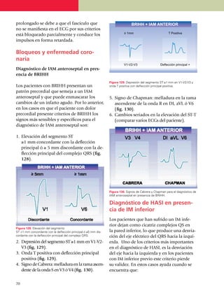 prolongado se debe a que el fascículo que
no se mani­fiesta en el ECG por sus criterios
está bloqueado parcial­mente y conduce los
impulsos en forma retardada.

Bloqueos y enfermedad coro­
naria
Diagnóstico de IAM anteroseptal en pres-
encia de BRIHH
                                                                Figura 129. Depresión del segmento ST ≥1 mm en V1-V2-V3 y
Los pacientes con BRIHH presentan un                            onda T positiva con deflección principal positiva.
patrón precordial que semeja a un IAM
antero­septal y que puede enmascarar los                        5.	 Signo de Chapman: mella­dura en la rama
cambios de un infarto agudo. Por lo anterior,                       ascendente de la onda R en DI, aVL ó V6
en los casos en que el paciente con dolor                           (fig. 130).
precordial presente criterios de BRIHH los                      6.	 Cambios seriados en la elevación del ST-T
signos más sensibles y específicos para el                          (compa­rar varios ECGs del pa­cien­te).
diagnóstico de IAM anteroseptal son:

1.	 Elevación del segmento ST
	 ≥1 mm concordante con la deflección
    principal ó ≥ 5 mm discordante con la de­
    flección principal del complejo QRS (fig.
    128).




                                                                Figura 130. Signos de Cabrera y Chapman para el diagnóstico de
                                                                IAM anteroseptal en presencia de BRIHH.

                                                                Diagnóstico de HASI en presen­
                                                                cia de IM inferior
                                                                Los pacientes que han sufrido un IM infe­
                                                                rior dejan como cicatriz complejos QS en
Figura 128. Elevación del segmento
ST >1 mm concordante con la deflección principal ó ≥5 mm dis­   la pared inferior, lo que produce una desvia­
cordante con la deflección principal del complejo QRS.          ción del eje eléctrico del QRS hacia la izqui­
2.	 Depresión del segmento ST ≥1 mm en V1-V2-                   erda. Uno de los criterios más impor­tantes
    V3 (fig. 129).                                              en el diagnóstico de HASI, es la des­viación
3.	 Onda T positiva con de­flección principal                   del eje hacia la izquierda y en los pacientes
    positiva (fig. 129).                                        con IM inferior previo este criterio pierde
4.	 Signo de Cabrera: melladura en la rama ascen­               su validez. En estos casos ayuda cuando se
    dente de la onda S en V3 ó V4 (fig. 130).                   encuentra que:

70
 